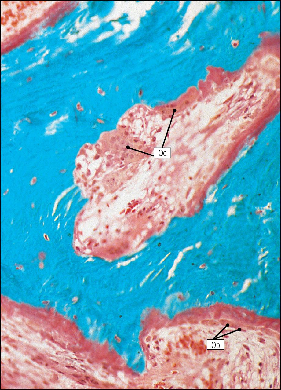 Fig. 13.24, Paget’s Disease.