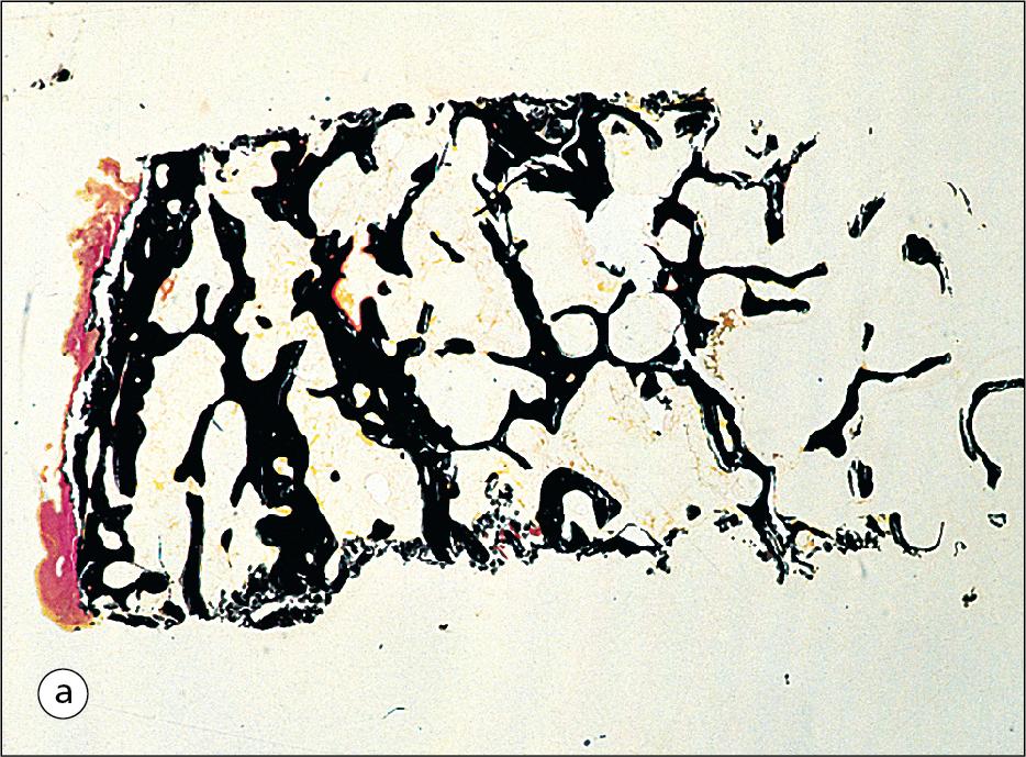 Fig. 13.23, Osteoporosis.