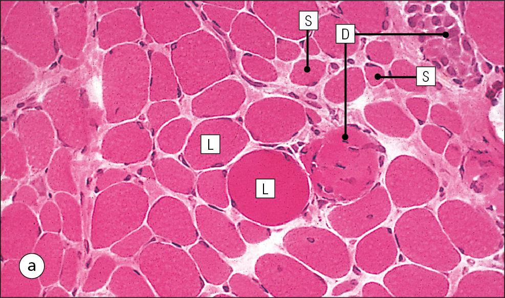 Fig. 13.6, Diseases of Muscle.