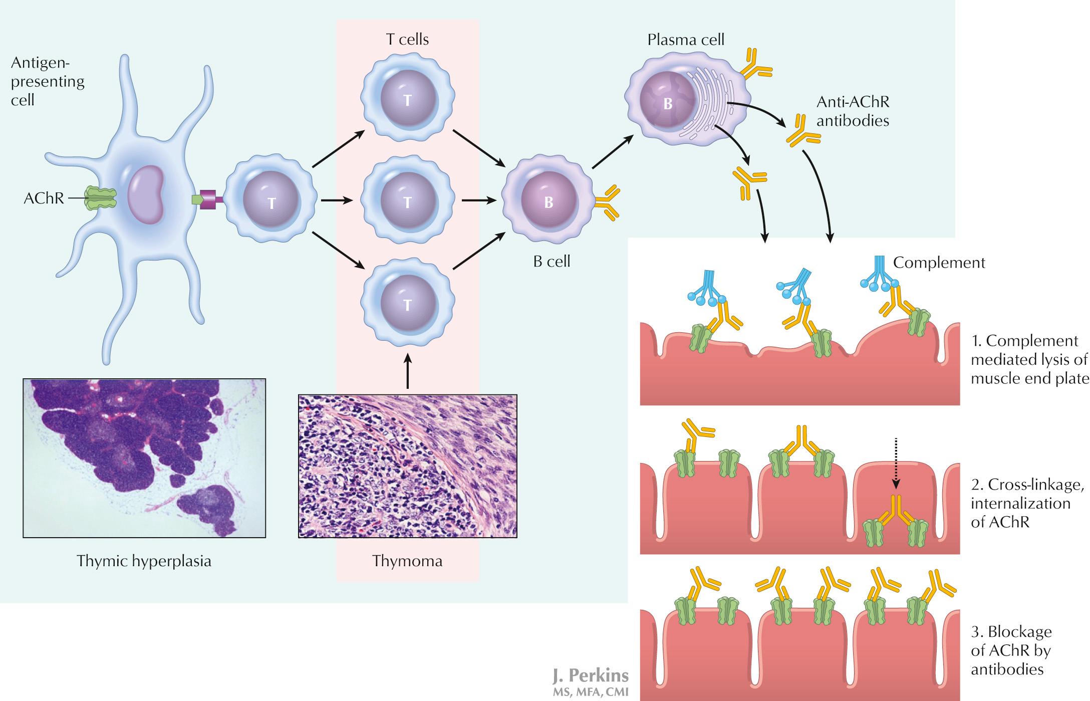 Fig. 68.4, Immunopathology of Myasthenia Gravis.