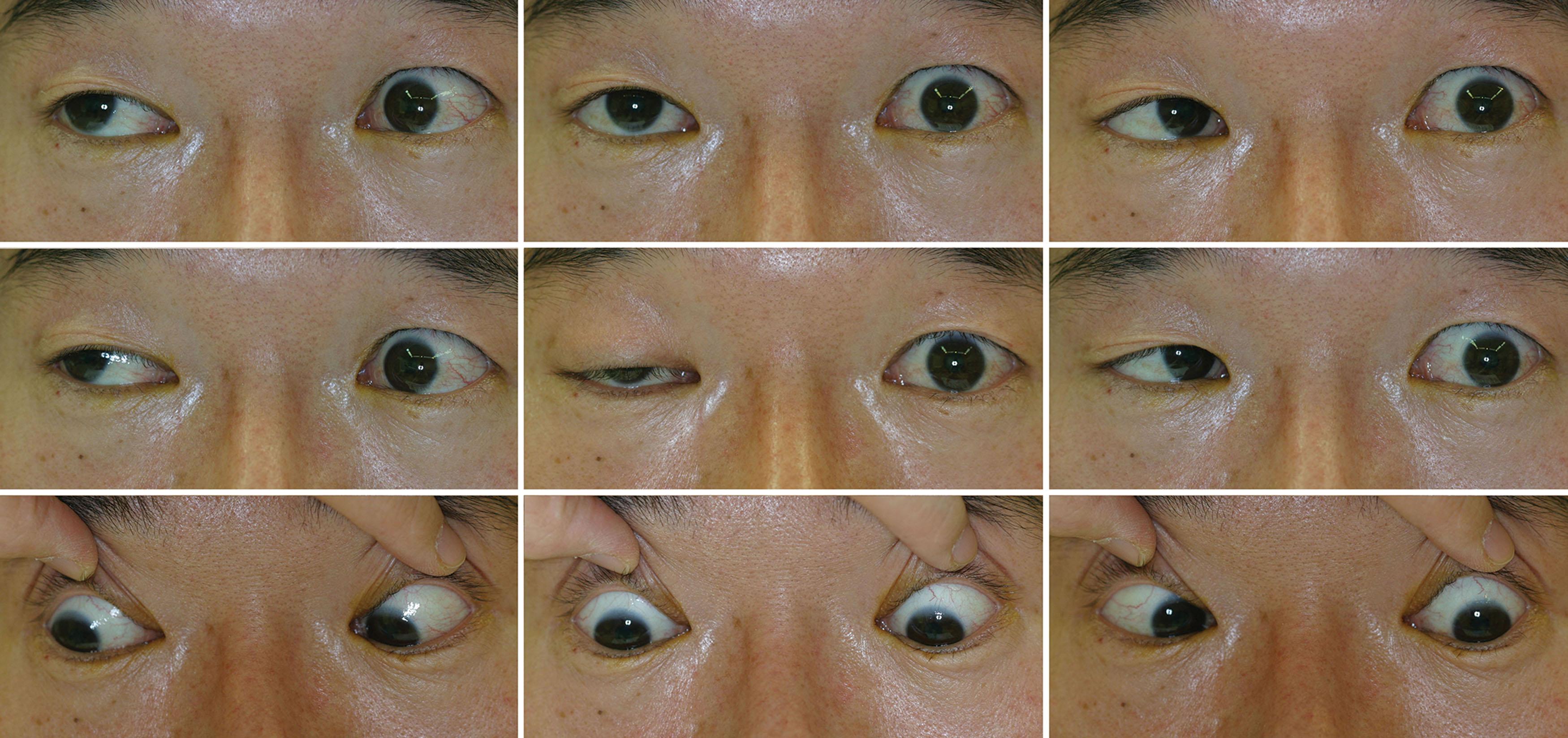 Fig. 86.1, Photographs of a patient with MG with variable degrees of ptosis of the right eye with time.