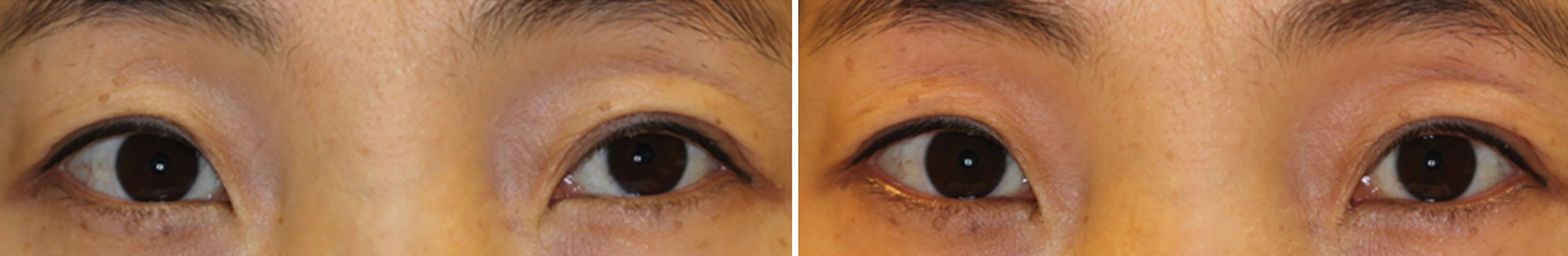 Fig. 86.2, Exotropia of 25 prism diopters (left) that improved to orthotropia (right) with the ice test.