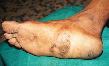 Figure 14-1, Eumycotic mycetoma of the foot. Early and localized tumor of the plantar area induced by Madurella mycetomi.