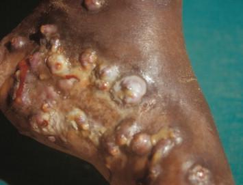 Figure 14-2, Eumycotic mycetoma of the foot due to Madurella mycetomi . Advanced tumor with swelling and draining sinuses is demonstrated.
