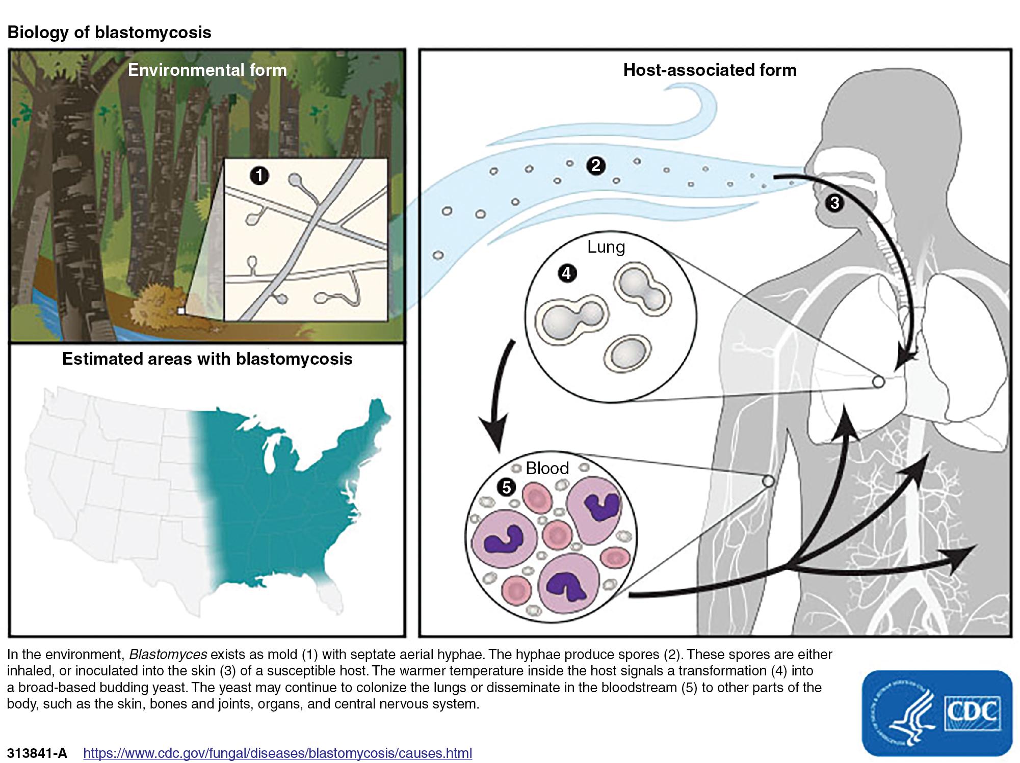 FIGURE 87.3, Geographic distribution of blastomycosis cases in the United States and transmission routes of the disease.