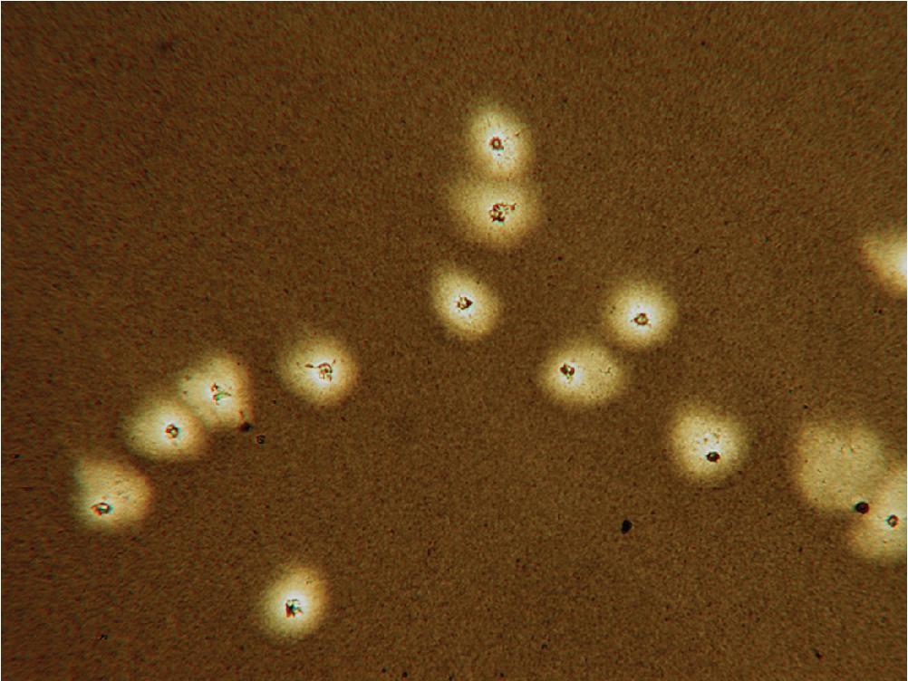 FIGURE 87.10, India ink–stained cerebrospinal fluid showing white blood cells with a halo, which mimic Cryptococcus spp. The uniform size and irregular form of the cells inside the halos, the absence of budding, and the hazy borders of the halos enable distinction from cryptococcal cells.