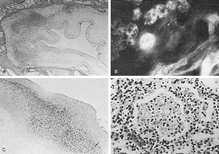 Figure 20-1, A, Section of placenta at 24 weeks of gestation showing extensive inflammation in amnion and chorion (magnification 25×). Ureaplasma was isolated from amniotic fluid 7 weeks before delivery and from multiple fetal organs at postmortem examination. B, Adjacent section of placenta stained with rabbit anti– Ureaplasma serovar 1 serum and reacted with fluorescein-labeled goat anti–rabbit immunoglobulin G (magnification 750×). C, Photomicrograph of umbilical cord from same case as in A and B shows extensive inflammation (magnification 25×). D, Photomicrograph of lung tissue shows histologic evidence of pneumonia (magnification 50×).