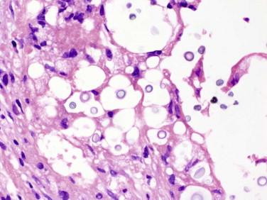 Fig 3, Cerebral cryptococcosis. At high magnification (H&E), organisms are round and have a distinctive capsule.