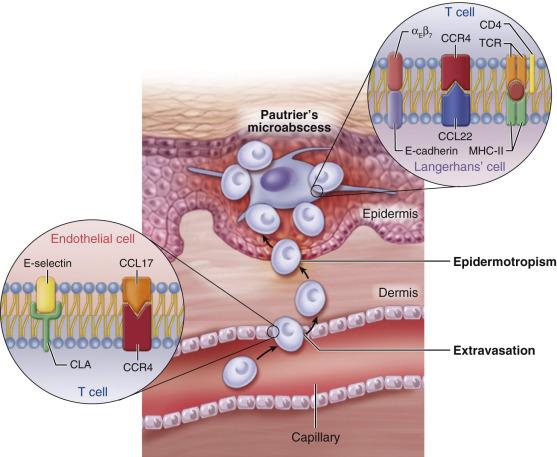 Fig. 91.1, Molecular pathology of mycosis fungoides. Activated skin-homing T cells extravasate through the dermal capillaries because of interactions of cutaneous lymphocyte antigen (CLA) and chemokine receptor 4 (CCR4) with their respective ligands on the dermal capillaries, E-selectin and chemokine ligand 17 (CCL17). T cells then migrate to the epidermis and interact with antigen-presenting dendritic cells.