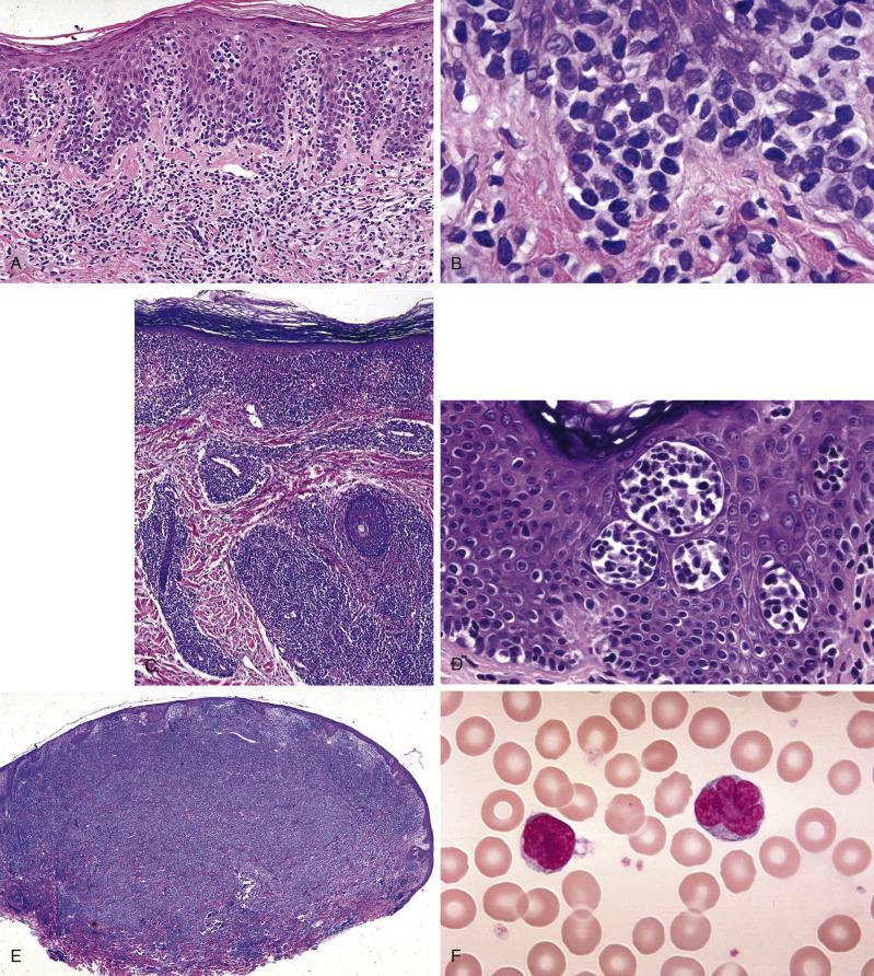 Fig. 91.2, Classic histopathologic findings in mycosis fungoides (MF) and Sézary syndrome. (A) Advanced patch-stage lesion of MF exhibiting abundant lymphocytes within the basal layer of the epidermis, associated with an underlying band-like lymphocytic infiltrate and papillary dermal fibrosis. (B) Advanced patch-stage lesion of MF exhibiting enlarged, convoluted lymphocytes within the epidermis. The lymphocyte cell size approximates the width of keratinocyte nuclei. (C) Plaque-stage MF shows, in addition, involvement of the reticular dermis. (D) Pautrier's microabscesses are well-defined aggregates of lymphocytes within the epidermis, which are strongly indicative of MF. (E) In tumor stage MF, the dermis is distended by the lymphocytic infiltrate. Epidermotropic capacity is often lost. (F) Sézary cells, such as the cell at the right, are enlarged circulating lymphocytes that exhibit cerebriform nuclear convolutions.