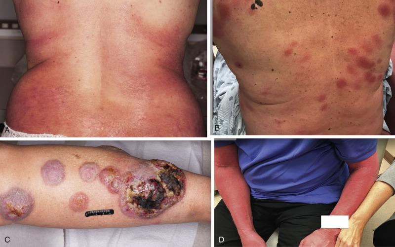 Fig. 91.3, Spectrum of cutaneous lesions observed in mycosis fungoides. (A) Patch stage. (B) Plaque stage. (C) Tumor stage. (D) Erythrodermic stage.