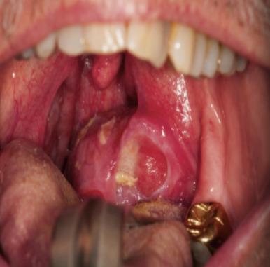 Fig. 91.4, Left pharyngeal involvement with mycosis fungoides.