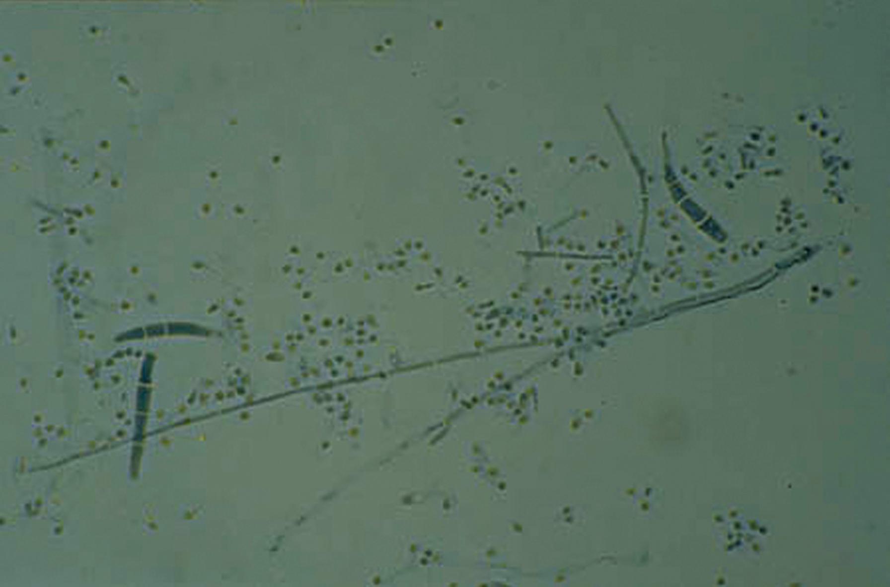 Fig. 60.11, Elongated macroconidia of Trichophyton mentagrophytes along with microconidia are lined up along the surface of the hypha.