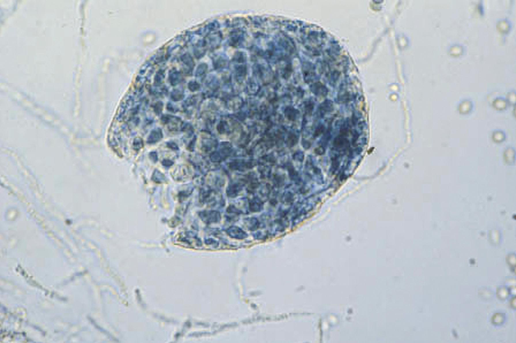 Fig. 60.13, Cleistothecium of Scedosporium boydii. This sexual reproductive structure is specifically referred to as an ascus containing ascospores.