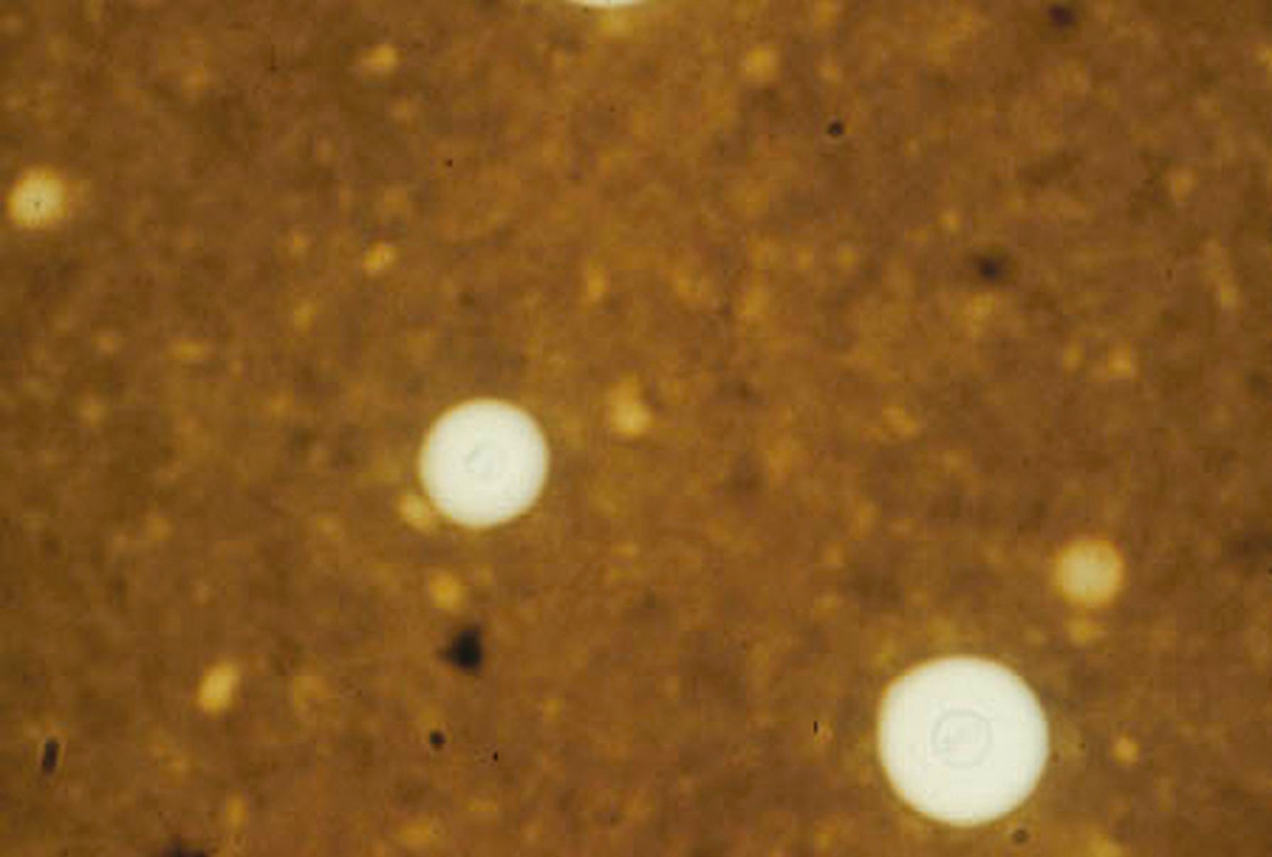 Fig. 60.14, India ink preparation of cerebrospinal fluid containing Cryptococcus neoformans . This yeast produces a characteristic polysaccharide capsule around the budding yeast cells. (400×.)