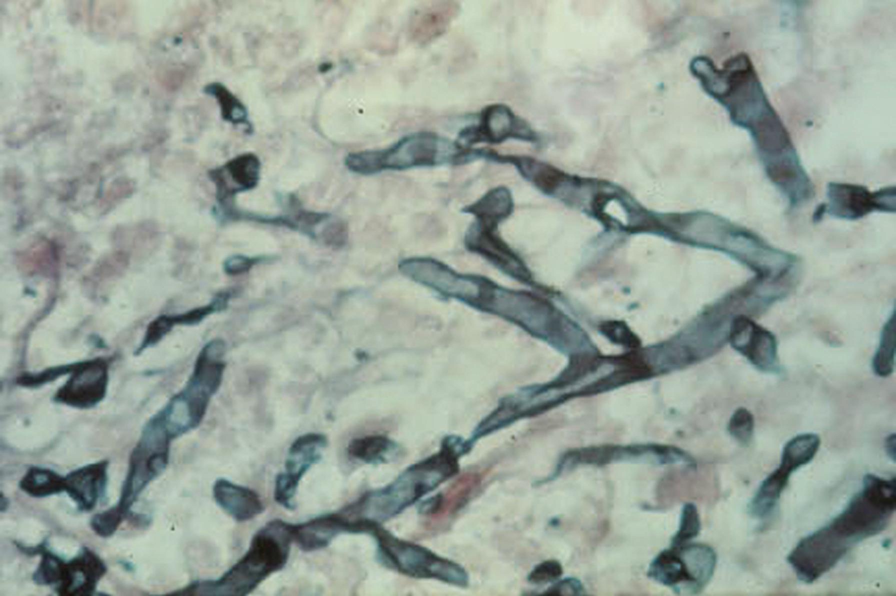 Fig. 60.3, Characteristic wide, nonseptate hypha of a mucormycete in lung tissue.