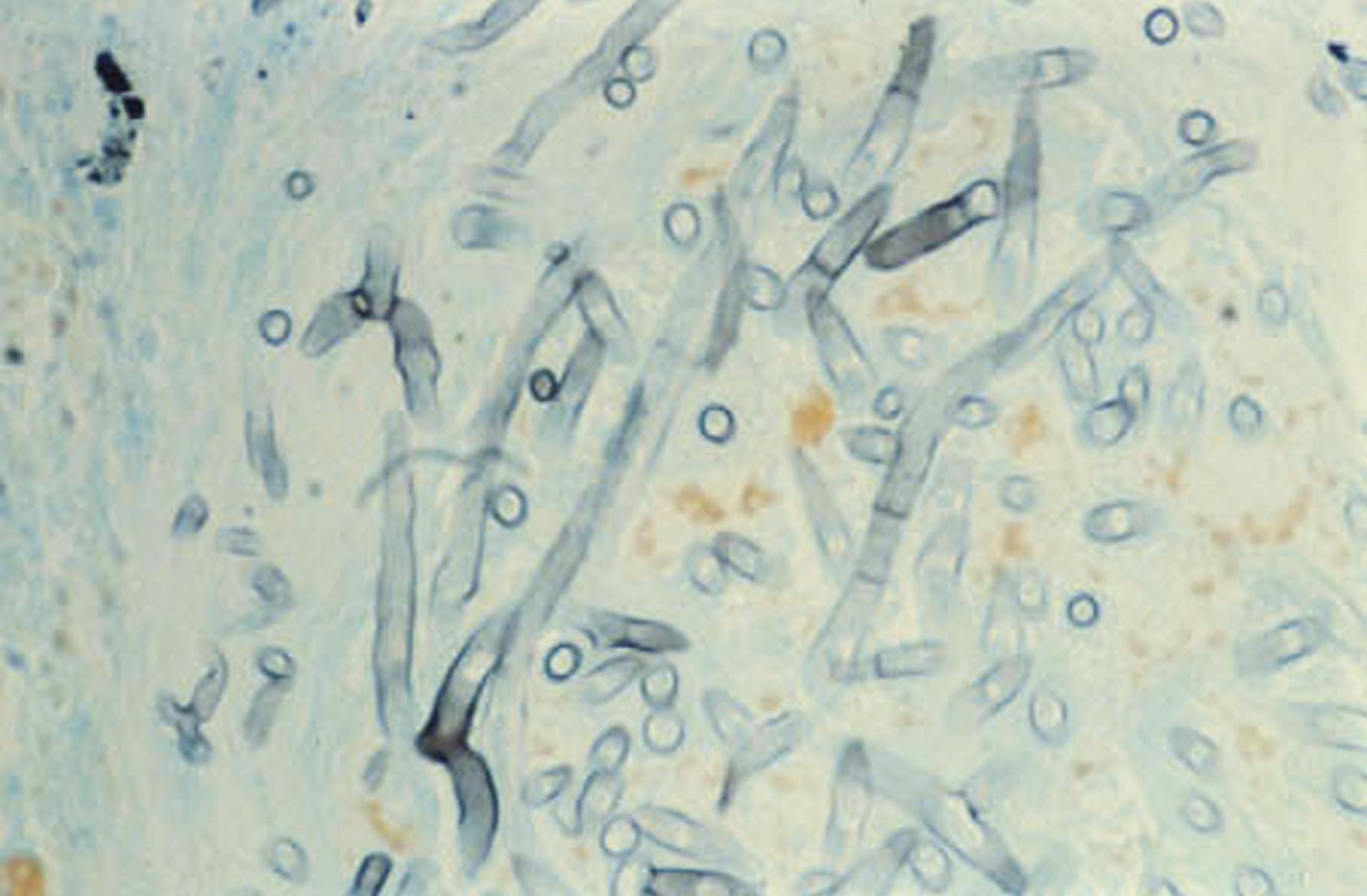 Fig. 60.4, Characteristic narrow branching, septate hyphae of a hyaline mold in tissue.