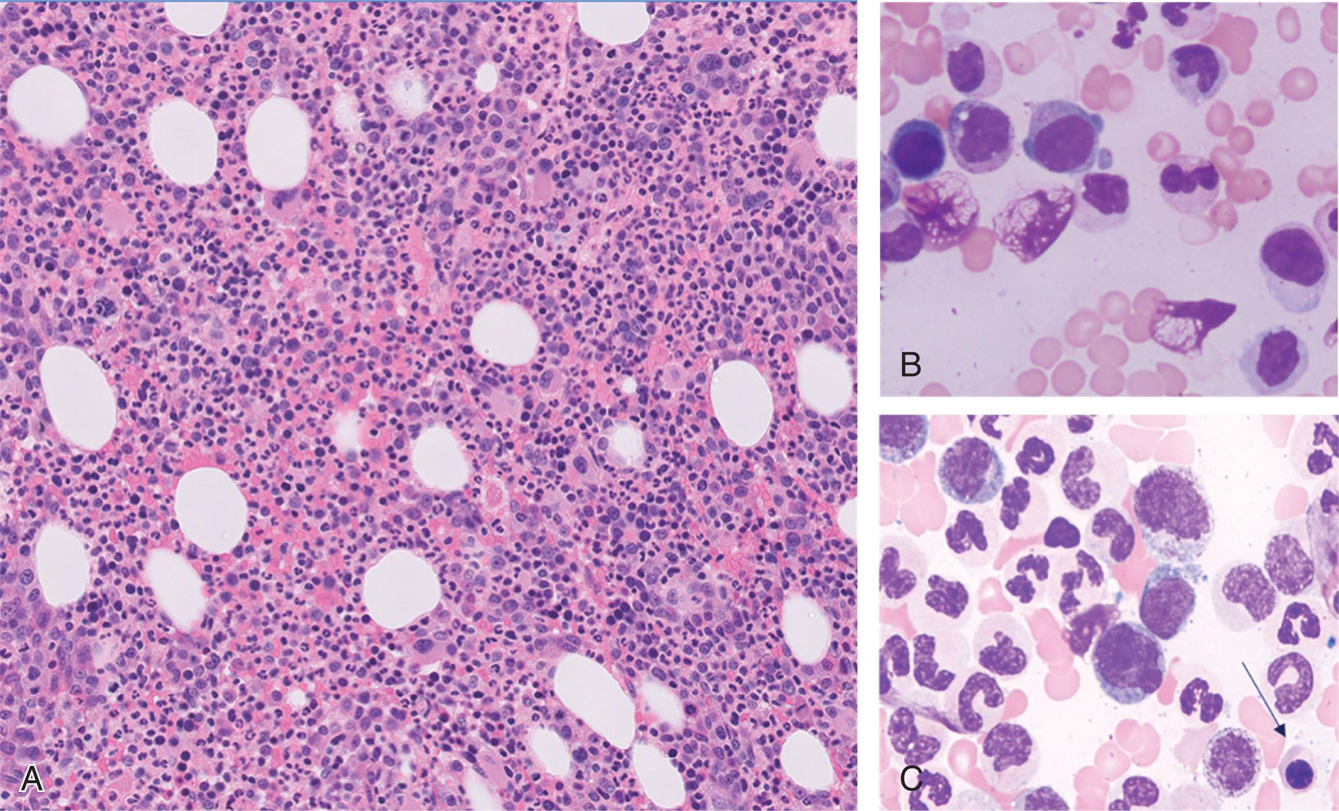 Figure 73.1, CHRONIC MYELOMONOCYTIC LEUKEMIA MORPHOLOGICAL FINDINGS.