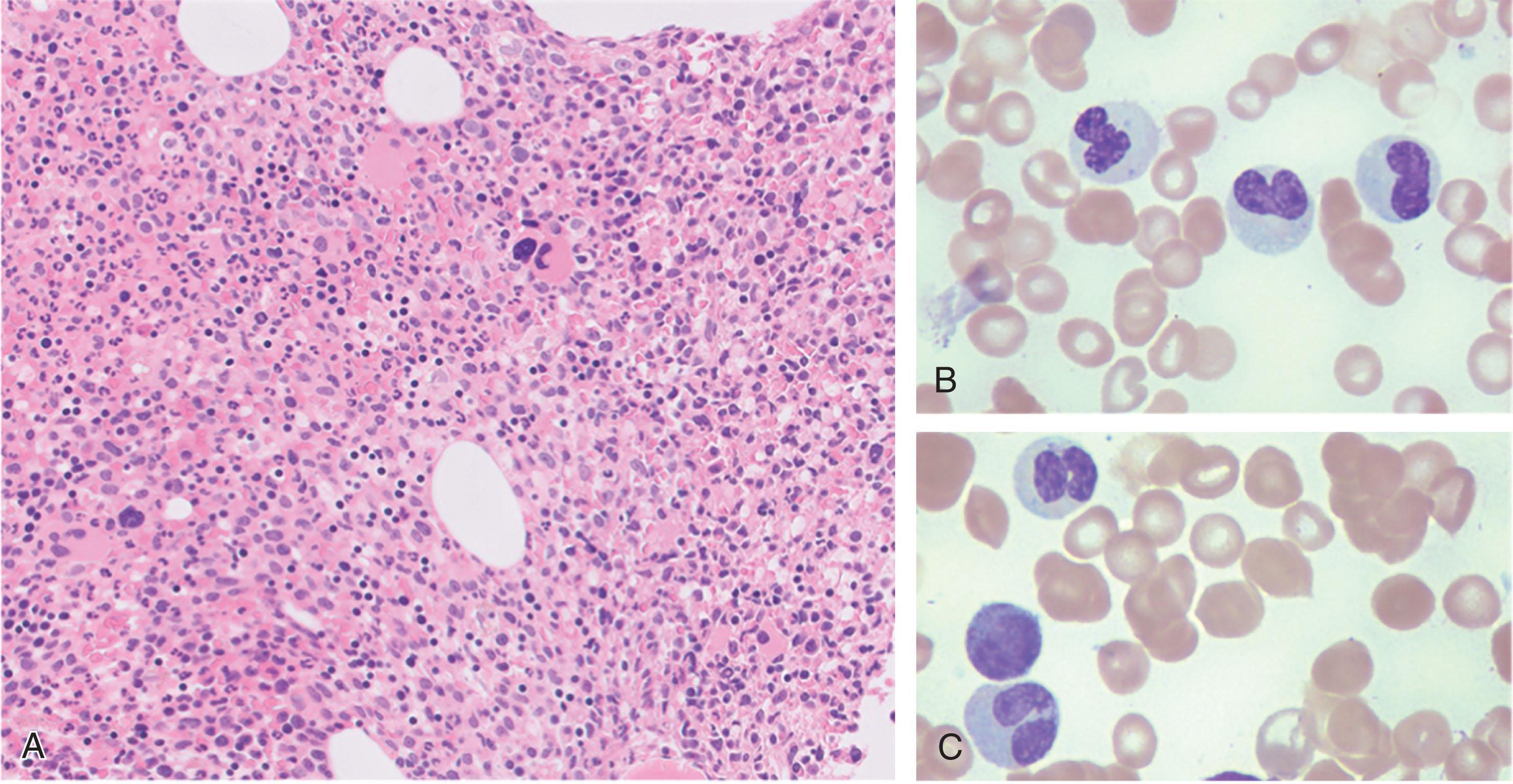 Figure 73.2, ATYPICAL CHRONIC MYELOID LEUKEMIA.