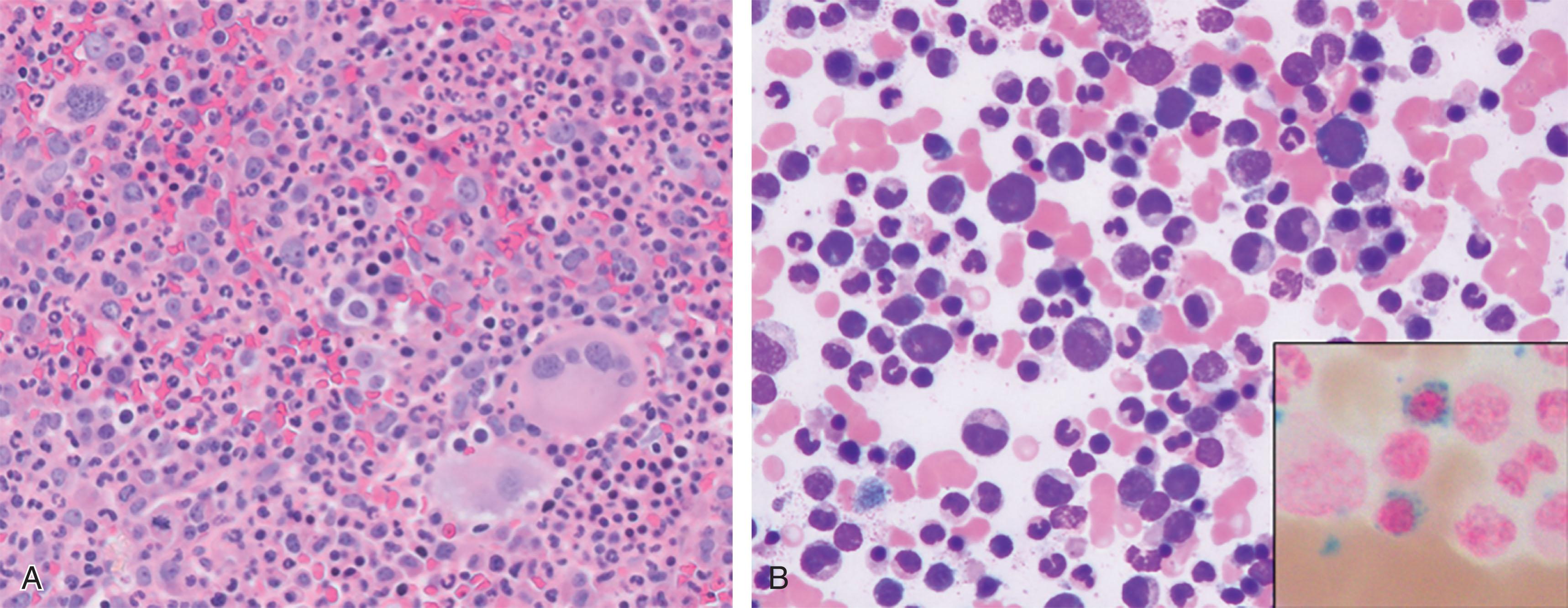 Figure 73.3, MYELODYSPLASTIC SYNDROME/MYELOPROLIFERATIVE NEOPLASM WITH RING SIDEROBLASTS AND THROMBOCYTOSIS.