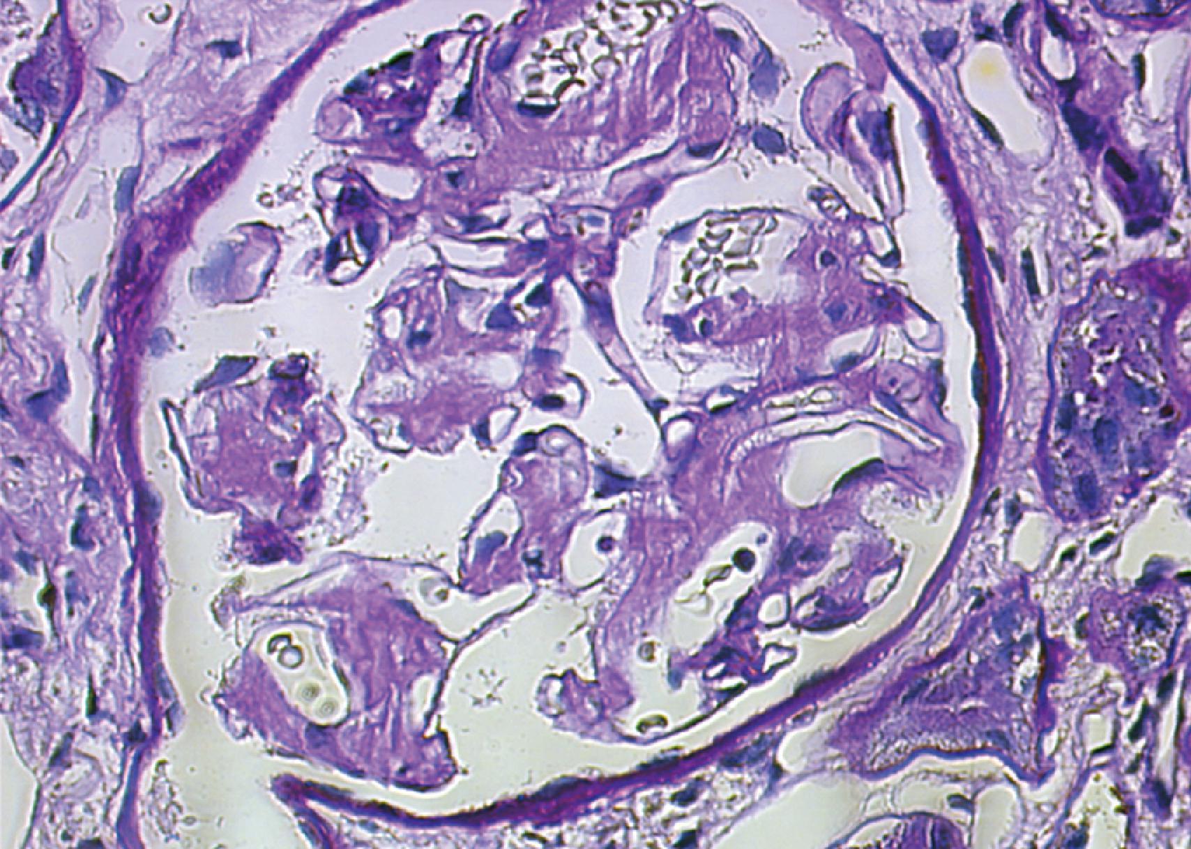 Fig. 28.2, Glomerulus from a patient with AL-type amyloidosis, showing segmentally variable accumulation of amorphous acidophilic material that is effacing portions of the glomerular architecture (PASH stain, magnification × 40).