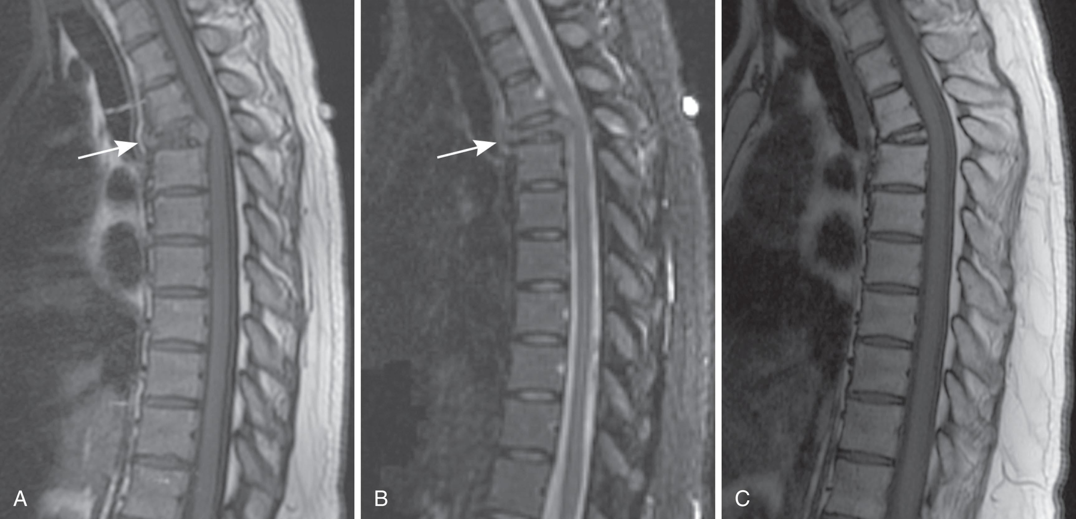 Figure 29.1, Plasmacytoma in a 46-year-old woman with a compression fracture of T4. Thoracic vertebrae are the most common site of solitary plasmacytoma of bone. T1-weighted sagittal magnetic resonance imaging (MRI) (A) and short tau inversion recovery (STIR) sagittal MRI ( B ) demonstrate loss of height of the vertebral body ( arrows ) with a convex contour to the central part of the posterior cortical margin, a shape that is more common in pathologic than in traumatic or osteoporotic compression fractures. The STIR image is atypical in that the signal in the collapsed vertebral body approximates that in other nearby vertebrae instead of being of higher intensity. Biopsy revealed a plasma cell neoplasm. No evidence was found of additional focal lesions, and so a plasmacytoma was diagnosed and treated by radiation with curative intent. C , T1-weighted sagittal MRI obtained 4.5 years later shows that the bulging of the posterior cortex has resolved, and the marrow signal in the collapsed T4 vertebral body matches that of other vertebrae.