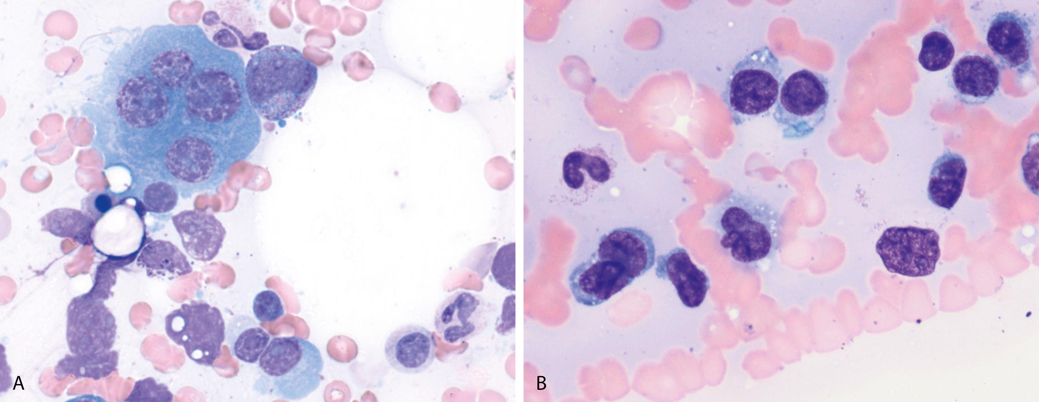 Fig. 14.11, Atypical morphologic features of plasma cell neoplasm. (A) Neoplastic plasma cells are large and multinucleated, sometimes mimicking osteoclasts. (B) In this case, the neoplastic plasma cells show monocytoid features with irregular folded nuclei.