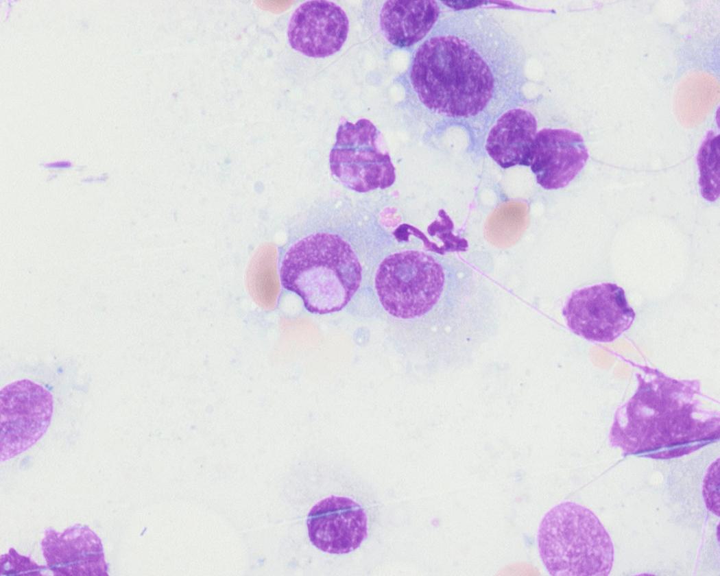 Fig. 14.12, Dutcher bodies are pseudo-intranuclear inclusions. They are cytoplasmic vacuoles containing immunoglobulins that invaginate into the nuclei (Wright-Giemsa stain).