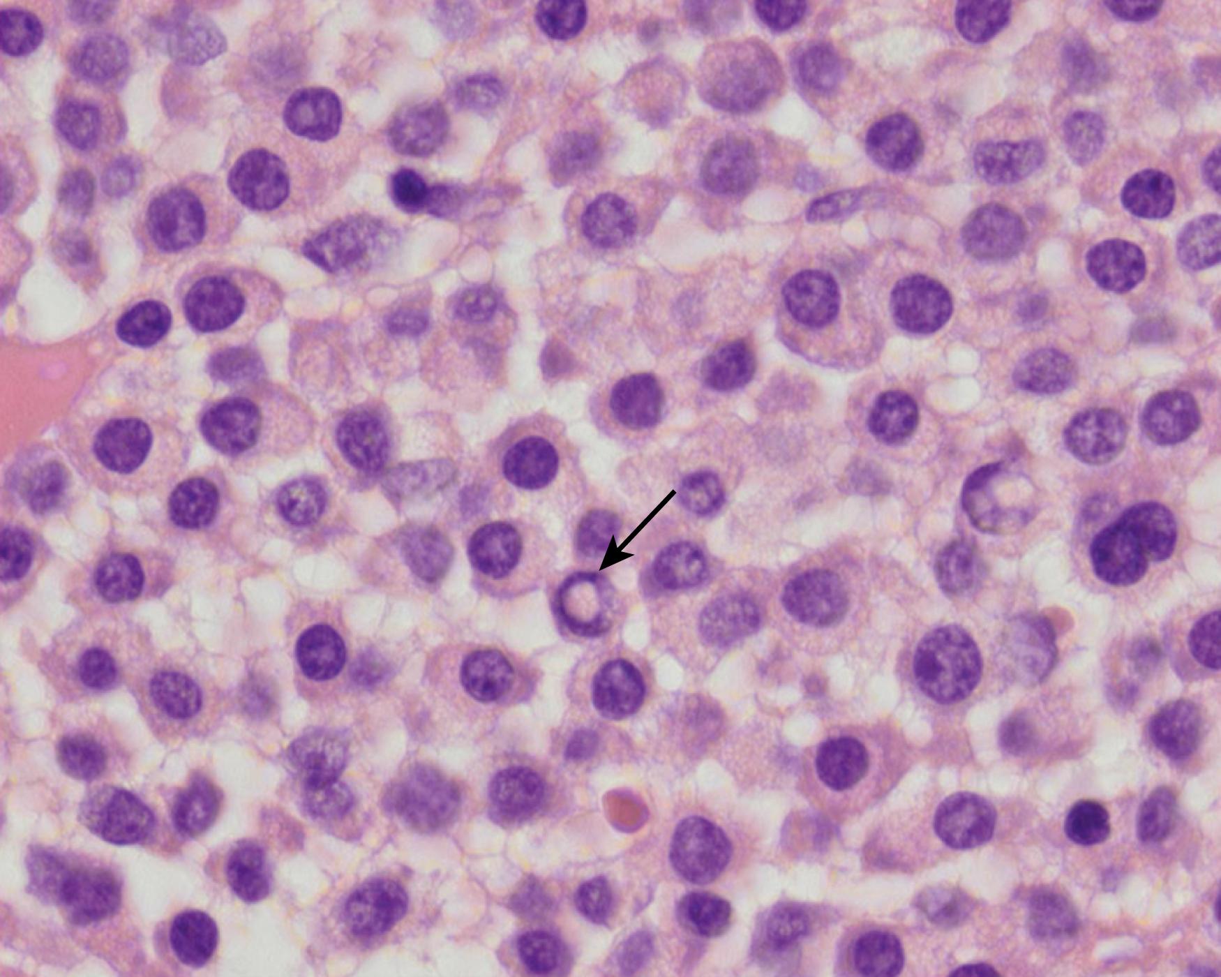 Fig. 14.13, Dutcher bodies. The corresponding trephine biopsy of the aspirate smear in Fig. 14.12 shows sheets of plasma cells with Dutcher bodies appreciated in some ( arrow ) (hematoxylin-eosin stain).