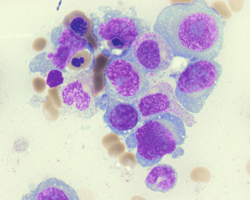 Fig. 14.17, Erythrophagocytosis. The neoplastic plasma cells in this case show frequent erythrophagocytosis. Nucleated red cells are engulfed by two plasma cells seen at the top left. There is also frequent dysplasia appreciated in the nucleated red cells with irregular nuclear contours, raising the possibility of an underlying myelodysplastic syndrome. The plasma cells in this case show immature/plasmablastic features. Studies have found increased risk of therapy related–myeloid neoplasm after treatment of MM. 103 , 104