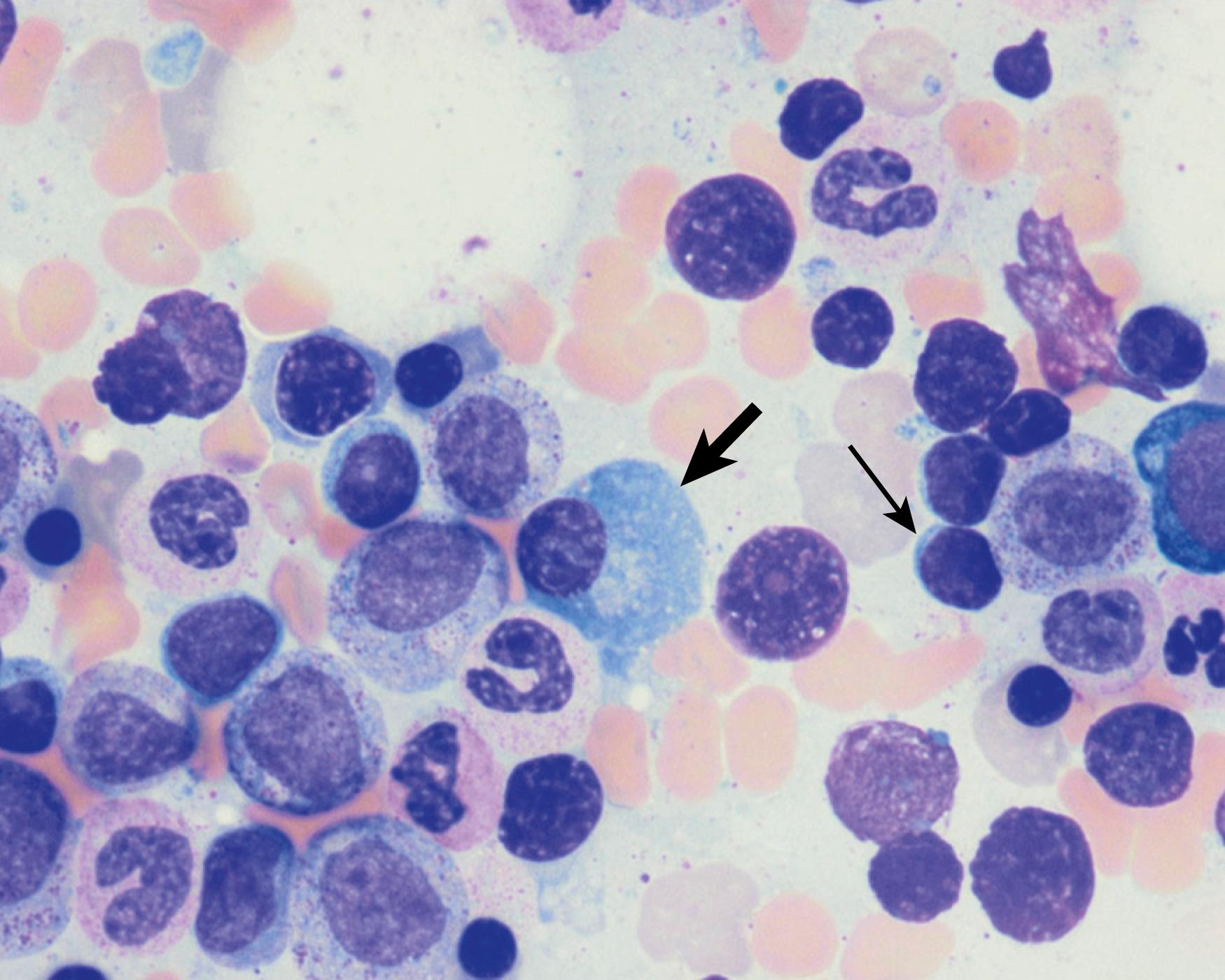 Fig. 14.2, Normal morphologic features of a plasma cell ( thick arrow ). The nucleus is eccentrically placed with coarse, clumped chromatin, ample basophilic cytoplasm, and paranuclear hof. A few small lymphocytes ( thin arrow ) are also present in the background, with round-ovoid nuclei, condensed chromatin, and a scant to moderate amount of cytoplasm (Wright-Giemsa stain).