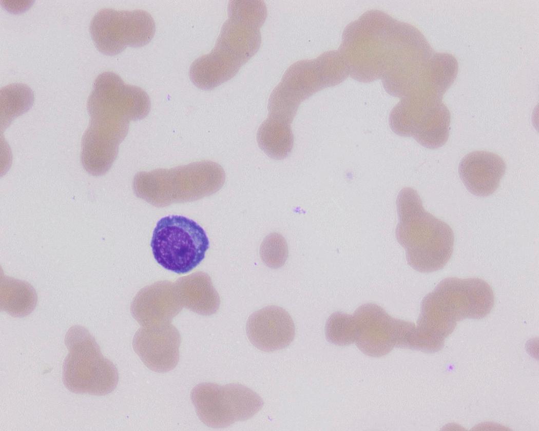 Fig. 14.21, Rouleaux formation. This peripheral blood smear from a case of secondary plasma cell leukemia shows red blood cells in a linear arrangement (“stacks of coins”) and a circulating plasma cell.
