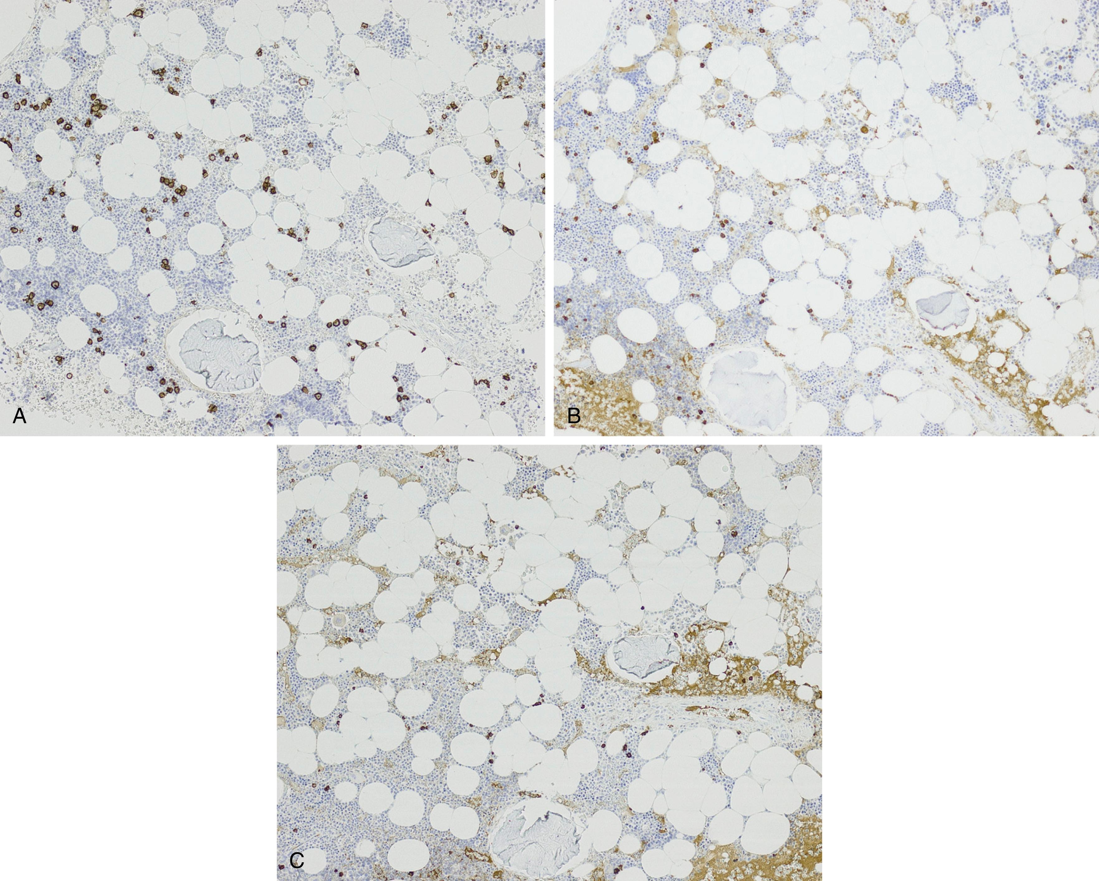 Fig. 14.22, Reactive plasmacytosis in a bone marrow. (A) CD138 stain highlights plasma cells that are dispersed interstitially. (B) and (C) show scattered intermixed κ- and λ-positive cells, respectively, with a slight predominance of κ.