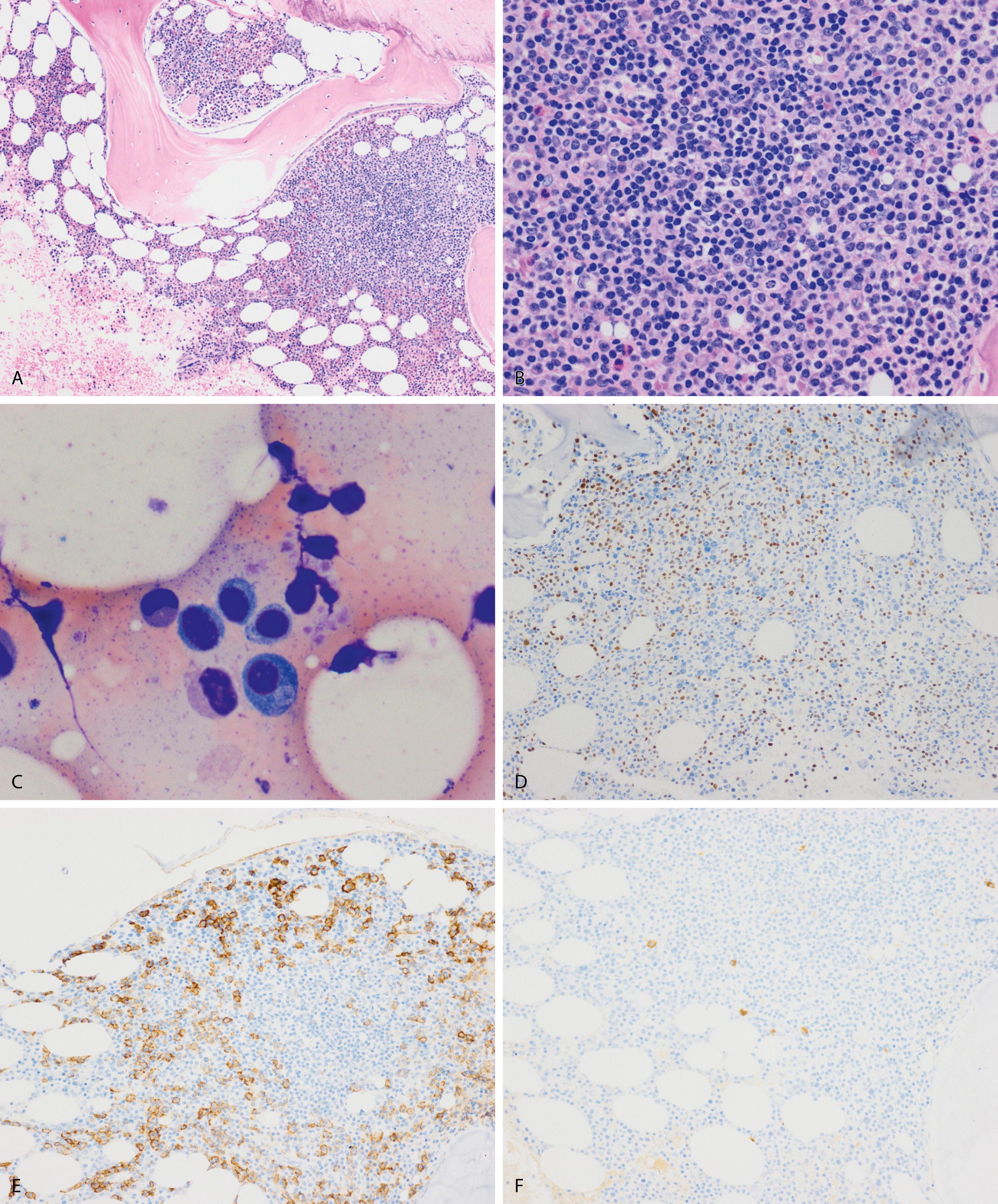 Fig. 14.23, Lymphoplasmacytic lymphoma. B-cell lymphoma exhibiting plasmacytic differentiation is a differential diagnosis with multiple myeloma. This case shows aggregates of small lymphocytes and intermixed plasma cells appreciated on the core biopsy (hematoxylin-eosin stain, A and B) and aspirate smear (C). B cells are highlighted with PAX5 (D) admixed with plasma cells seen with a CD138 stain (E). κ and λ Light chain stains