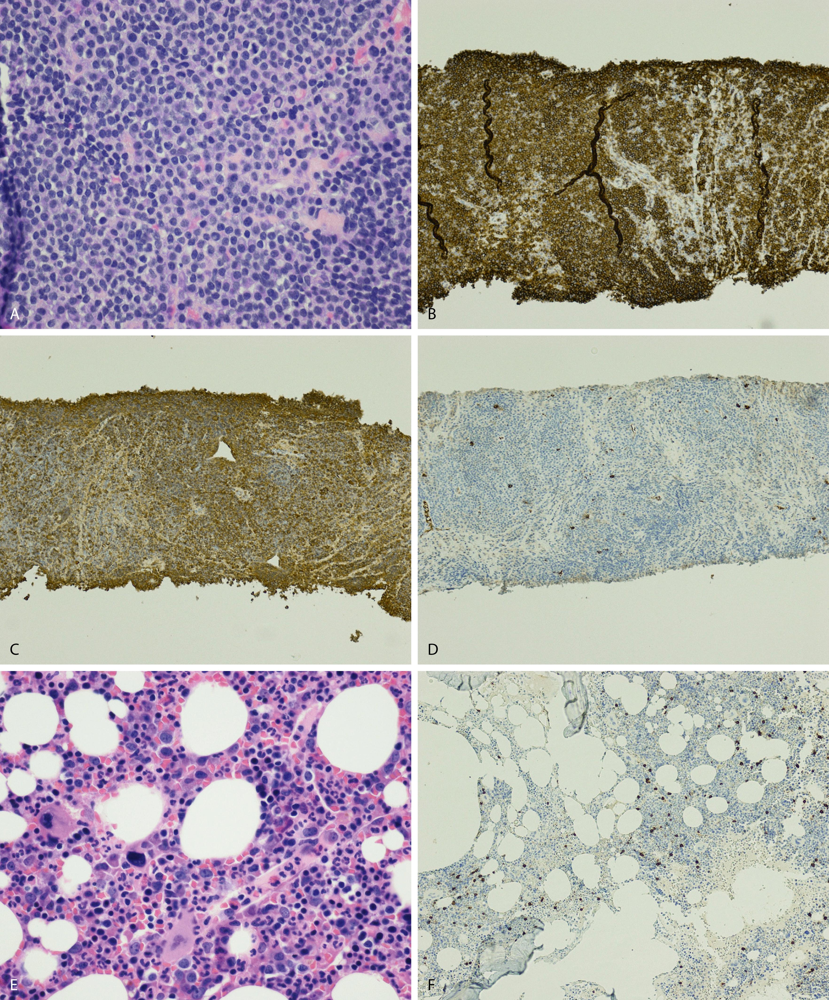 Fig. 14.24, Panels (A) to (J) show a case of lymphoplasmacytic lymphoma/Waldenström macroglobulinemia (LPL/WM) involving a lymph node with concurrent plasma cell neoplasm involving the bone marrow. Panels (K) to (Q) show a case of dural-based extranodal marginal zone lymphoma with marked plasmacytic differentiation. In the first case (A–J), the LPL component in the lymph node (A–D) shows intermixed lymphocytes and plasma cells with Dutcher bodies appreciated in some of the plasma cells (hematoxylin-eosin stain, A). CD20 shows diffuse proliferation of B-cells (B) demonstrating κ light-chain restriction (C). λ Stain shows sparse staining cells (D). In the bone marrow (E–J), there is a heterogeneous population of cells (hematoxylin-eosin stain, E). B cells highlighted with CD20 (F) are sparse. Interstitial plasma cells are seen with a CD138 stain forming loose clusters