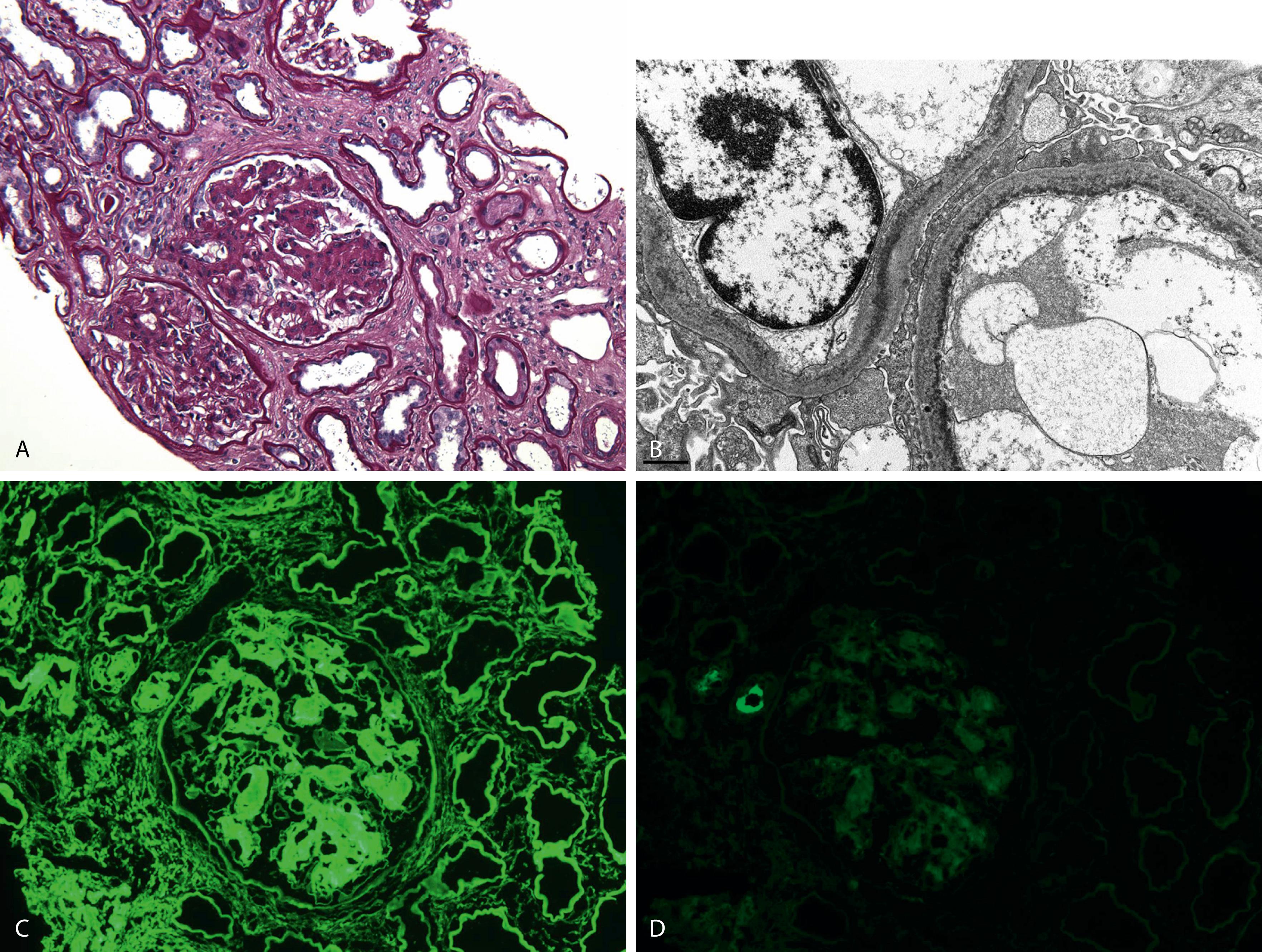 Fig. 14.27, Light-chain deposition disease (LCDD). (A) The glomerulus in LCDD shows nodular glomerulosclerosis that mimics the pattern of nodular sclerosis in diabetic nephropathy. Notice the thickening of adjacent tubular basement membranes (periodic acid–Schiff stain). (B) Ultrastructural examination shows the dense, powdery punctate deposition of light-chain material along glomerular basement membranes (transmission electron microscope). (C) Direct immunofluorescence shows linear staining along the tubular basement membranes and the mesangium of glomeruli for κ light chain and negative staining for λ light chain (D).