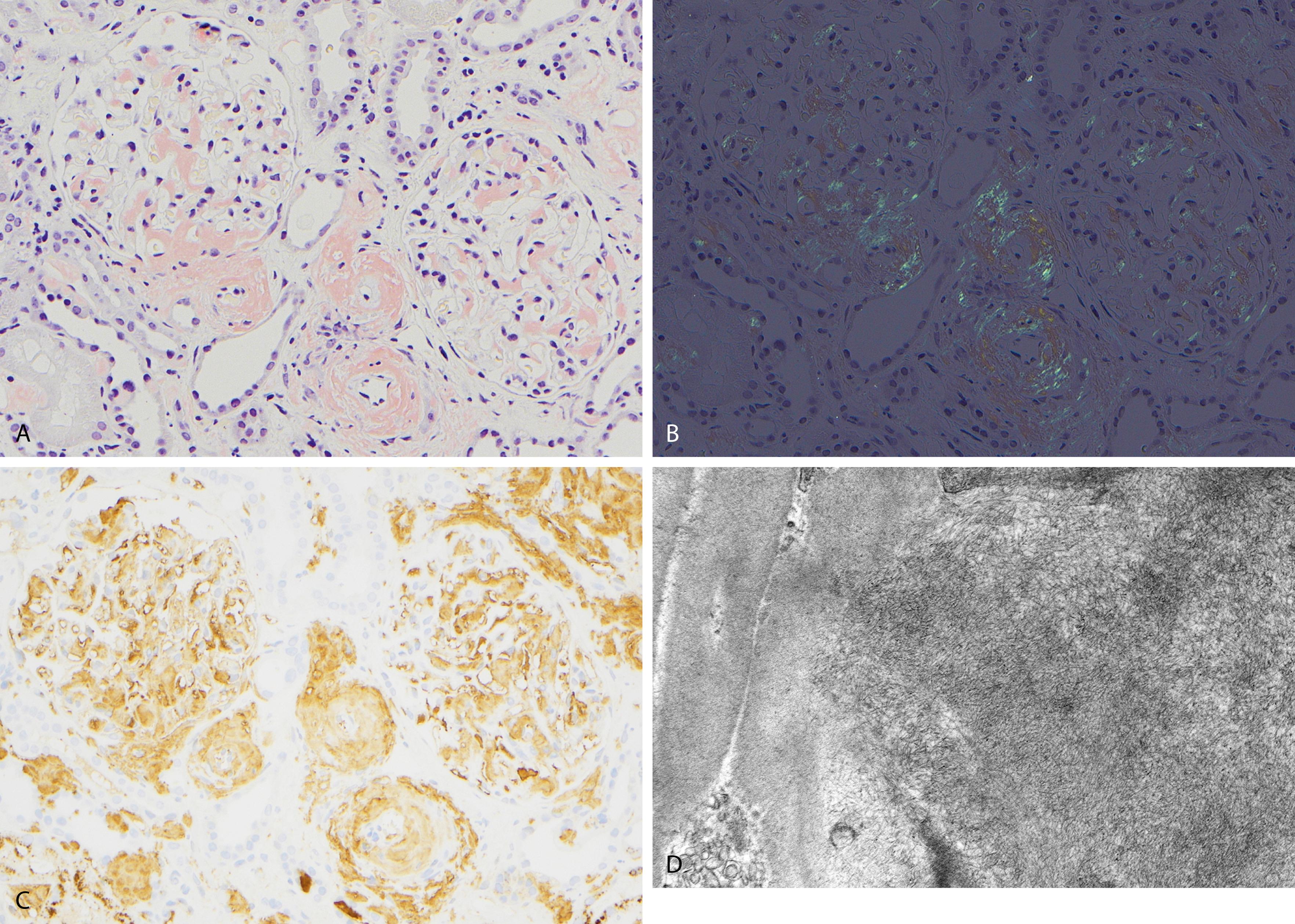 Fig. 14.28, Light-chain amyloid (AL) κ light-chain–type. (A) A Congo red stain highlights amyloid deposits that are orange-red involving the mesangium of the glomeruli and the arterioles. (B) Amyloid deposits show characteristic apple-green birefringence when viewed under polarized microscope. (C) Immunoperoxidase stain with anti-κ antibodies shows strong staining of amyloid deposits in the glomeruli and the arterioles. The reactivity of the amyloid is negative for λ light chains (not shown). (D) Ultrastructural examination shows randomly disposed, rigid, nonbranching, variably long amyloid fibrils within the tissue.