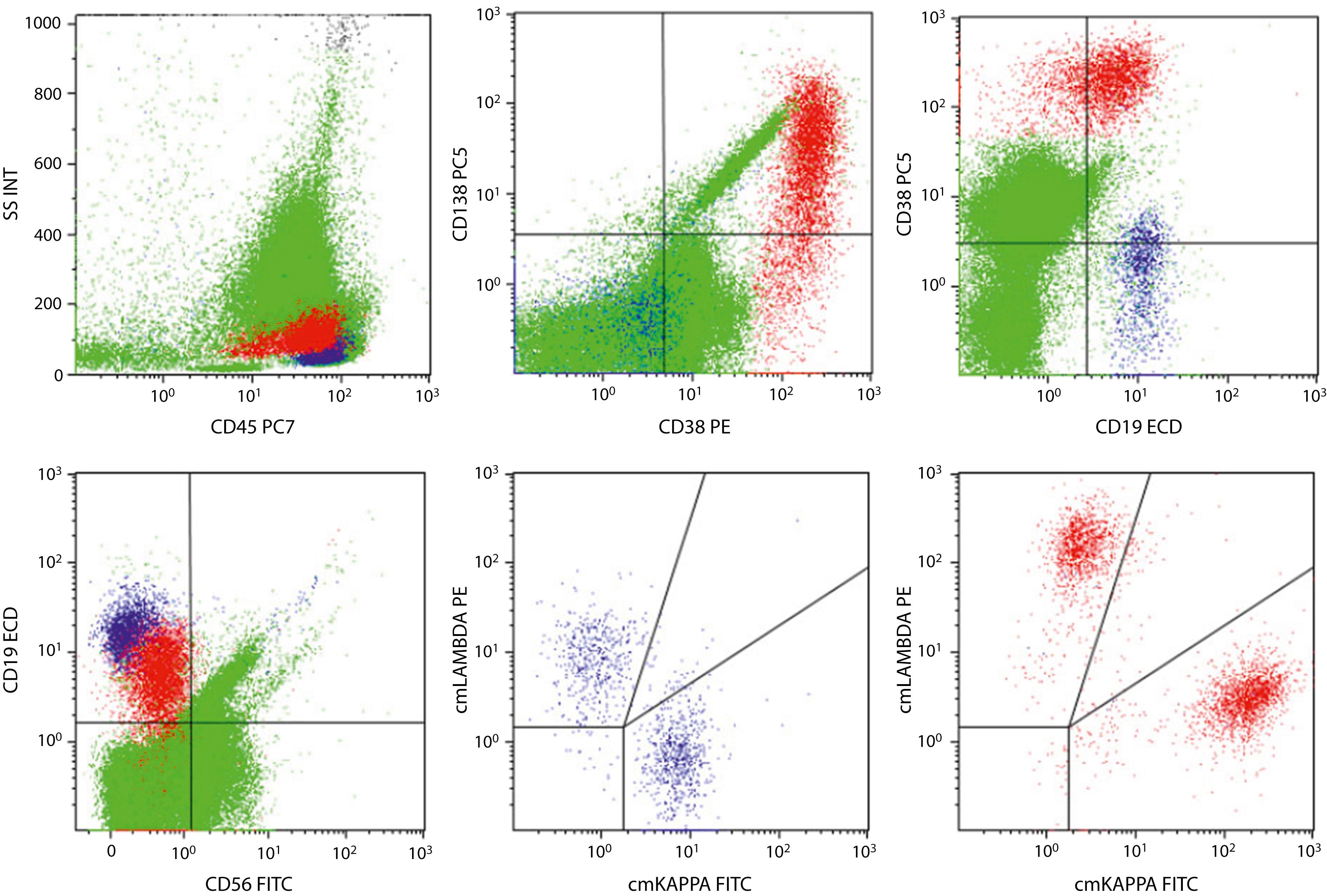 Fig. 14.29, This flow cytometric analysis included plasma cell panel composed of CD45, CD38, CD138, CD19, CD56, and cytoplasmic (cm) kappa and lambda light chain antibodies. Antibodies are labeled with different fluorochromes (PC5, PC7, PE, ECD, and FITC). The plasma cells ( red ) show CD45 + , CD38 + , CD138variable, CD19dim, and CD56 − with a polytypic κ and λ light-chain expression, consistent with a normal population of plasma cells. CD19 + B-cells ( blue ) are polytypic. The plasma cells show brighter CD38 expression compared with the B cells. There is downregulation of CD138 in the plasma cell population; this pattern is thought to be a result of cell degeneration and/or effects of the anticoagulation in the sample.