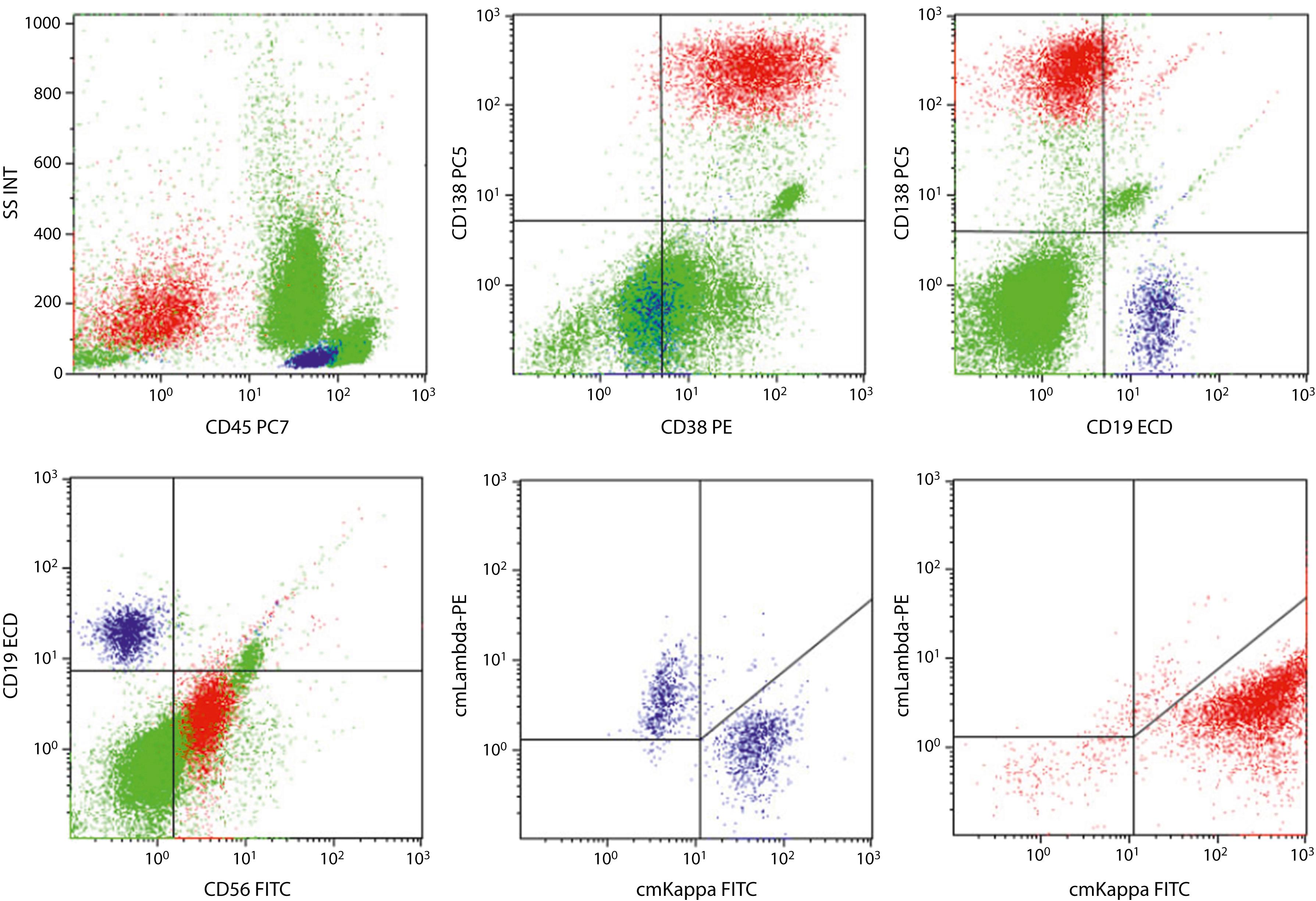 Fig. 14.31, Flow cytometric analysis of a peripheral blood sample showing a monotypic plasma cell population ( red ) and polytypic B cells ( blue ). The plasma cells (12%–16% of total events or cells) are CD45 − , CD138+, CD38 + (bright), CD19 − , and CD56 + with κ light-chain restriction. The B cells (4.3% of total) are CD45 + (bright) and CD19+ with a κ/λ ratio of approximately 2:1. Plasma cells are often underrepresented in flow cytometric studies owing to the fragility of these cells; therefore, correlation with morphologic findings, in this case a peripheral blood smear, is advised. The plasma cell flow cytometry panel here included CD45, CD38, CD138, CD19, CD56, and cytoplasmic (cm) kappa and lambda light chain antibodies. Antibodies are labeled with different fluorochromes (PC5, PC7, PE, ECD, and FITC).