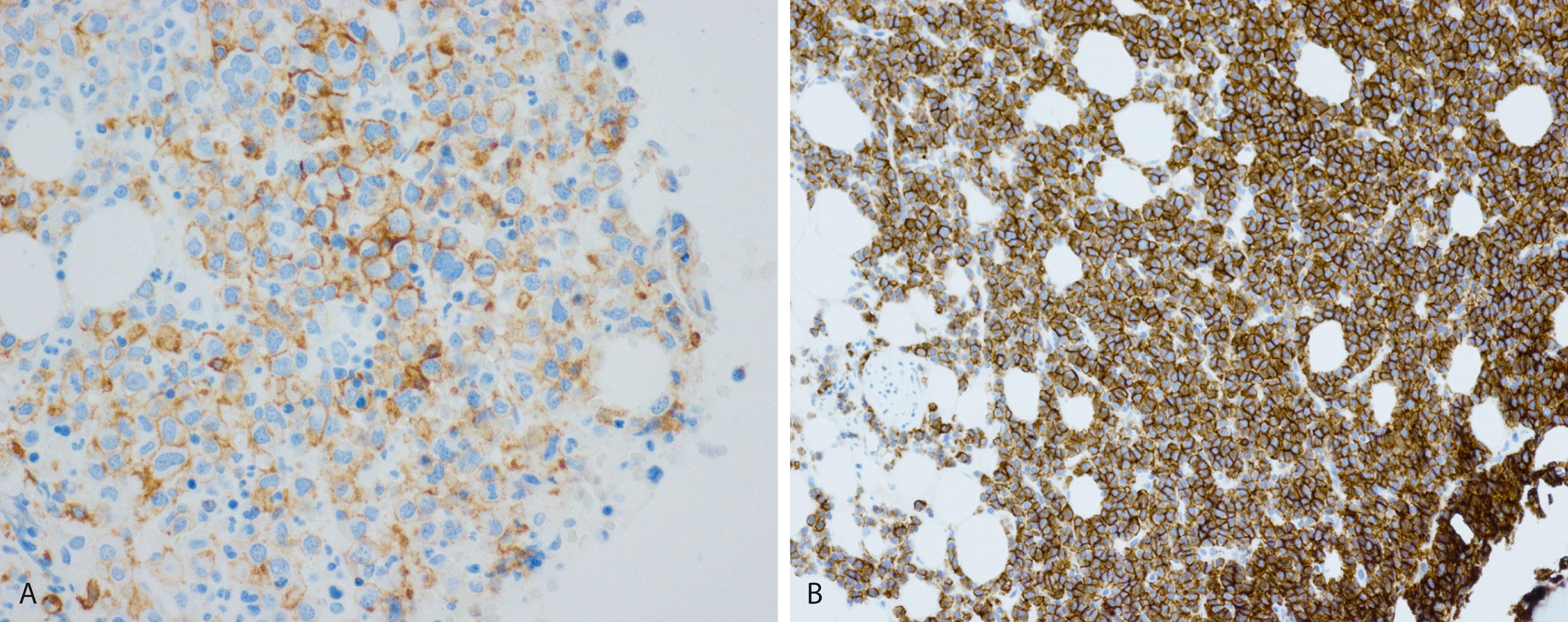 Fig. 14.32, The cases presented in Figs. 14.7 and 14.8 show aberrant CD56 expression (A). The case presented in Figs. 14.9 and 14.10 shows aberrant expression of CD20 (B).