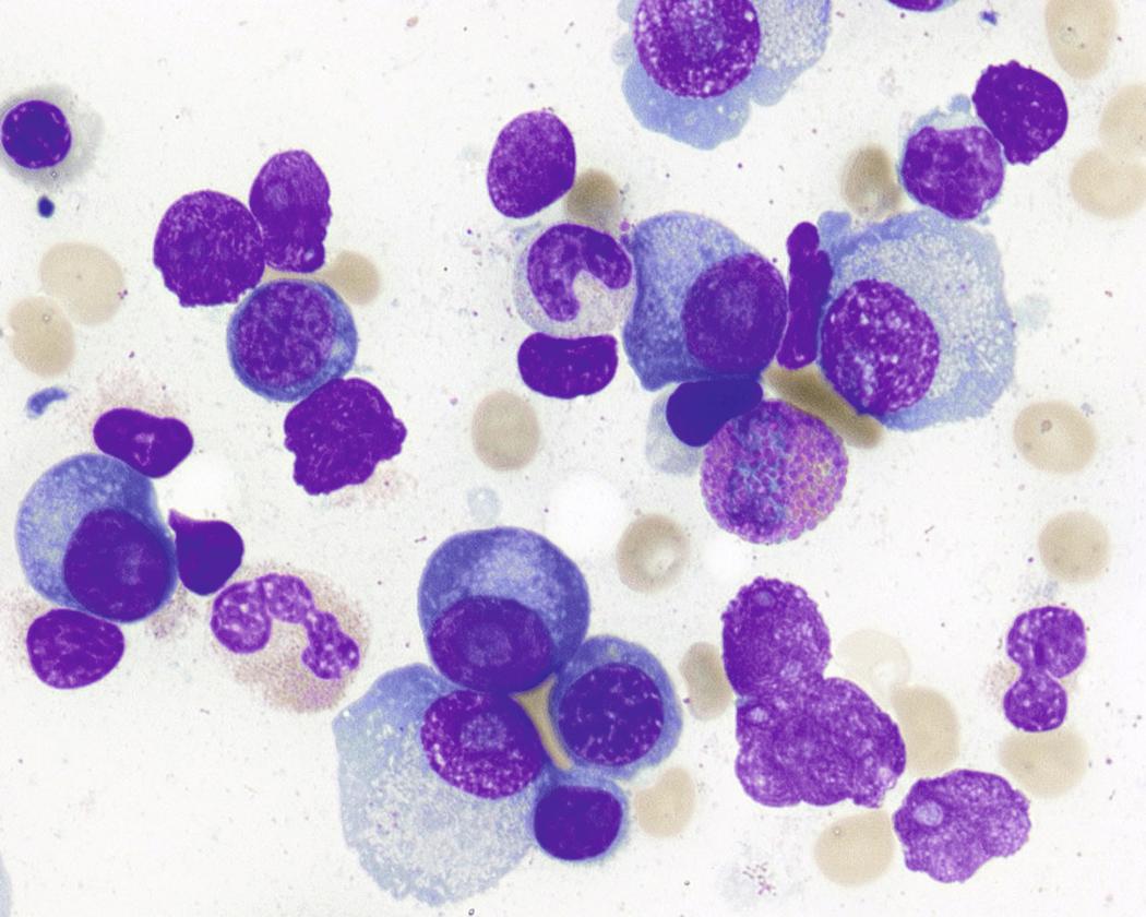 Fig. 14.4, Immature morphology. The neoplastic plasma cells in this case show immature morphologic features. The nuclei exhibit more open chromatin and prominent nucleoli. There is ample cytoplasm and eccentrically placed nuclei (Wright-Giemsa stain).