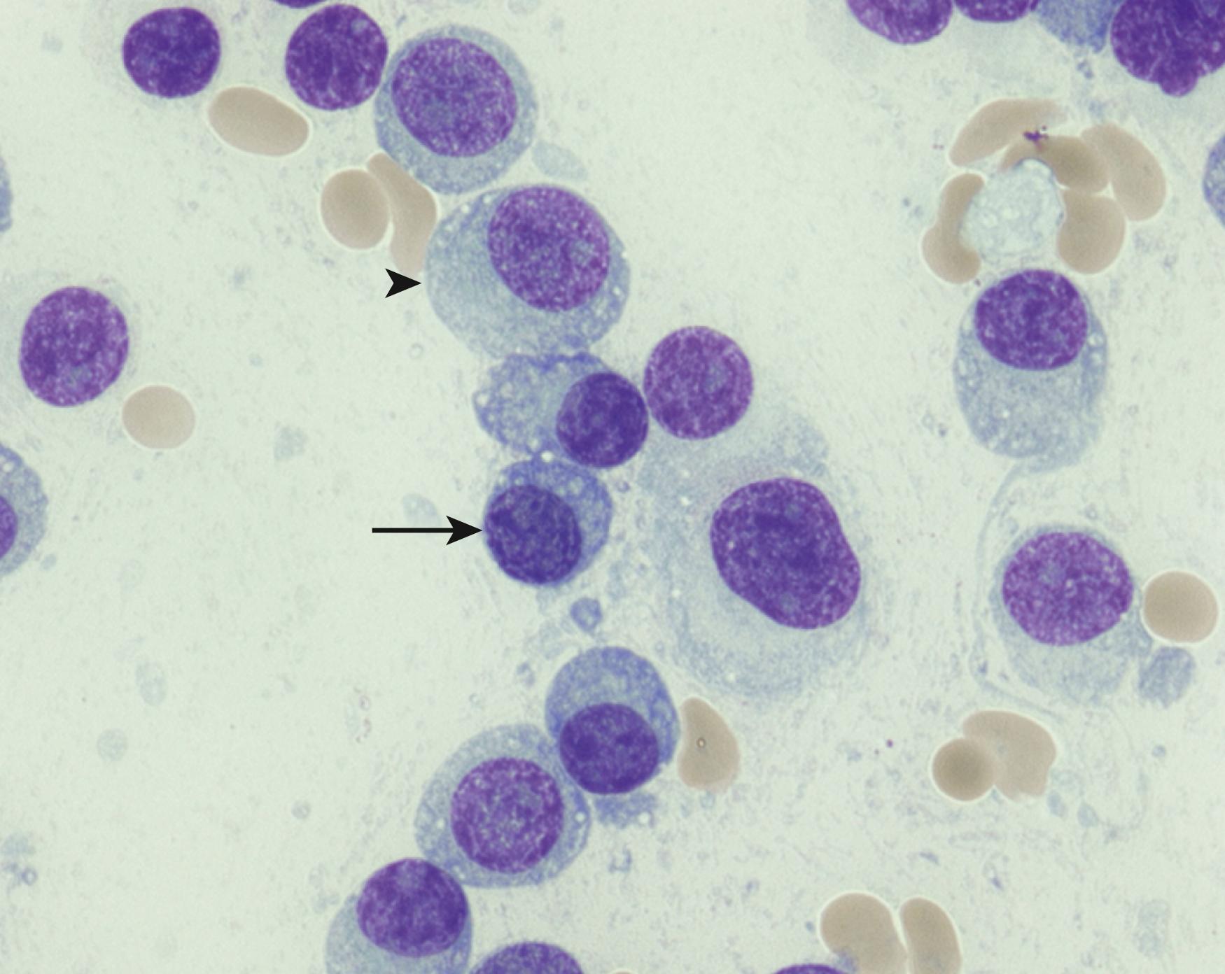 Fig. 14.6, Plasma cell myeloma with features intermediate between mature and immature morphology. A subset of the neoplastic plasma cells demonstrates mature features ( arrow ) and others demonstrate less condensed chromatin and distinct nucleoli ( arrowhead ) (Wright-Giemsa stain).