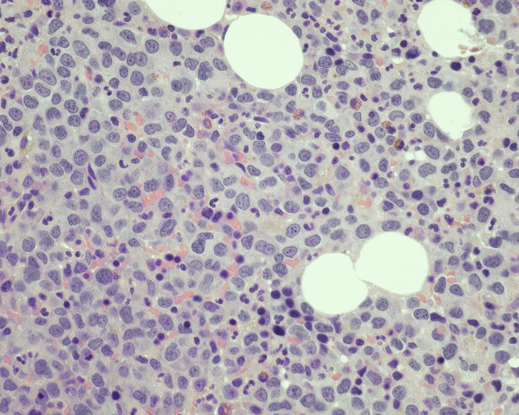 Fig. 14.8, Plasmablastic morphology. The corresponding trephine biopsy of the aspirate smear in Fig. 14.6 shows sheets of atypical plasma cells that are poorly differentiated and resembling blasts. The nucleoli are prominent and the chromatin is open/fine (hematoxylin-eosin stain).