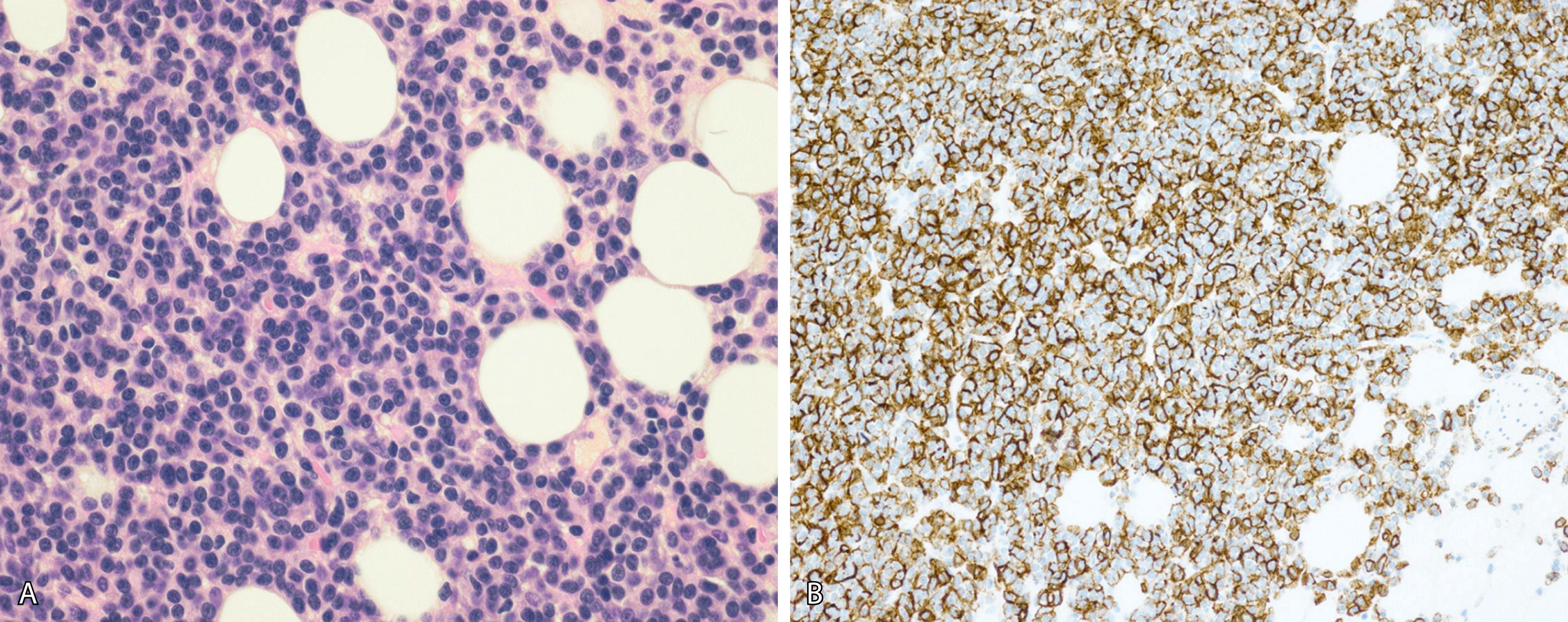 Fig. 14.10, Lymphoplasmacytoid morphology. (A) The corresponding trephine biopsy of the aspirate smear in Fig. 14.9 (hematoxylin-eosin stain). (B) CD138 stain is useful in identifying the plasma cell lineage of the cells.