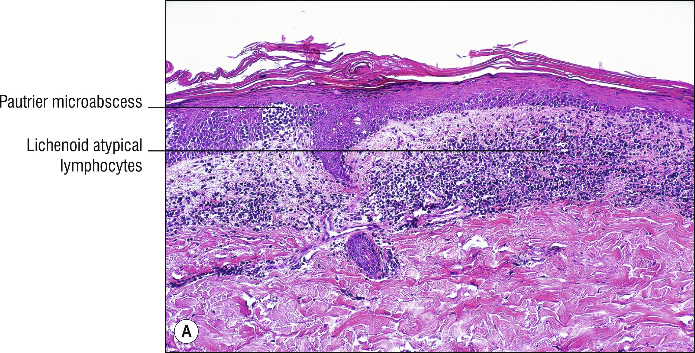 Fig. 24.1, A Mycosis fungoides (low mag.).