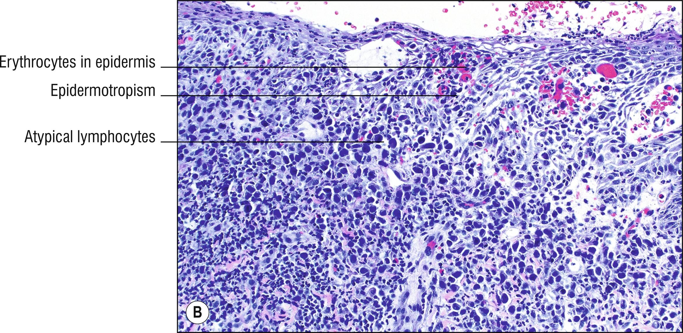 Fig. 24.5, B Lymphomatoid papulosis (medium mag.).