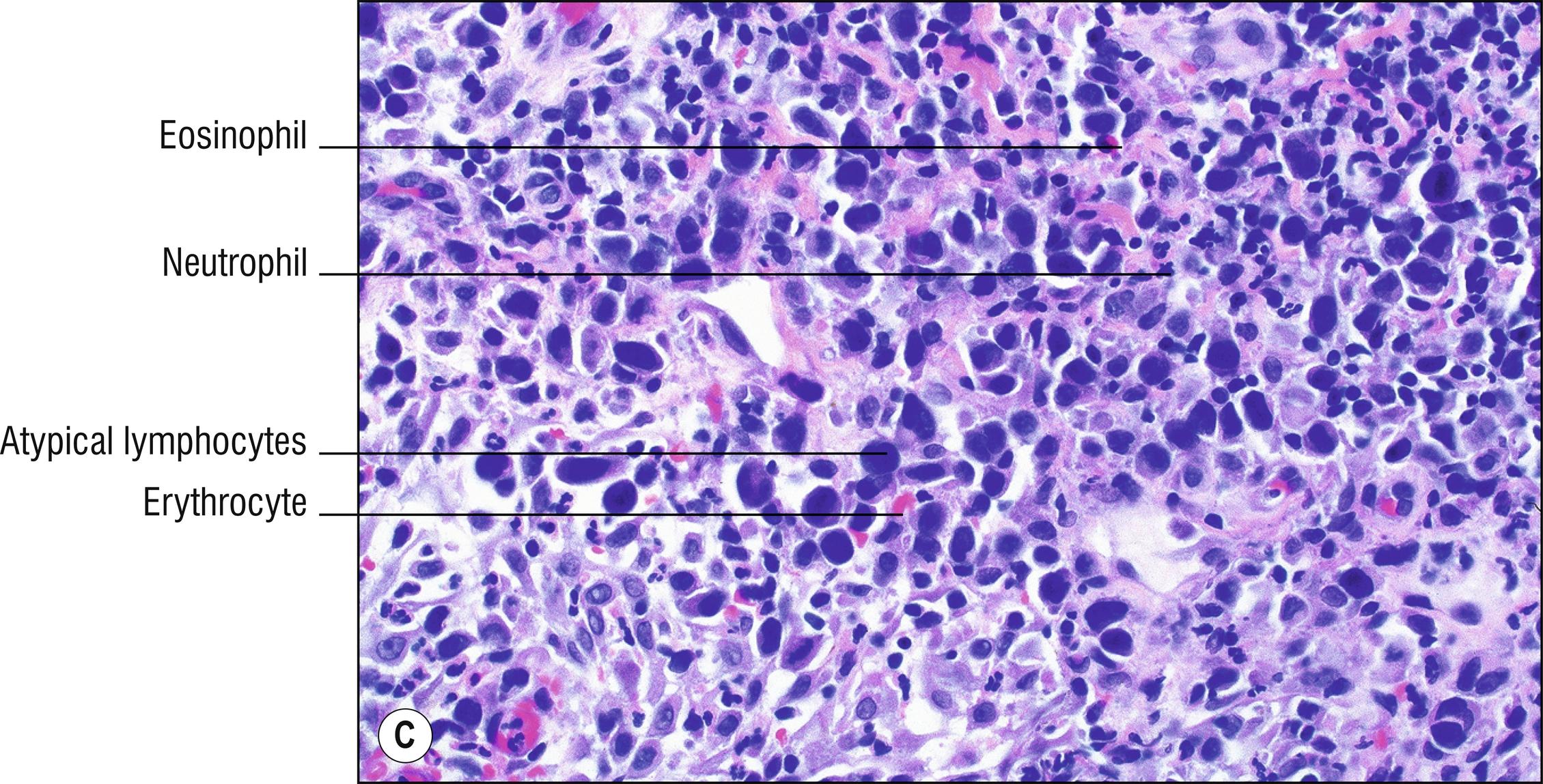 Fig. 24.5, C Lymphomatoid papulosis (high mag.).