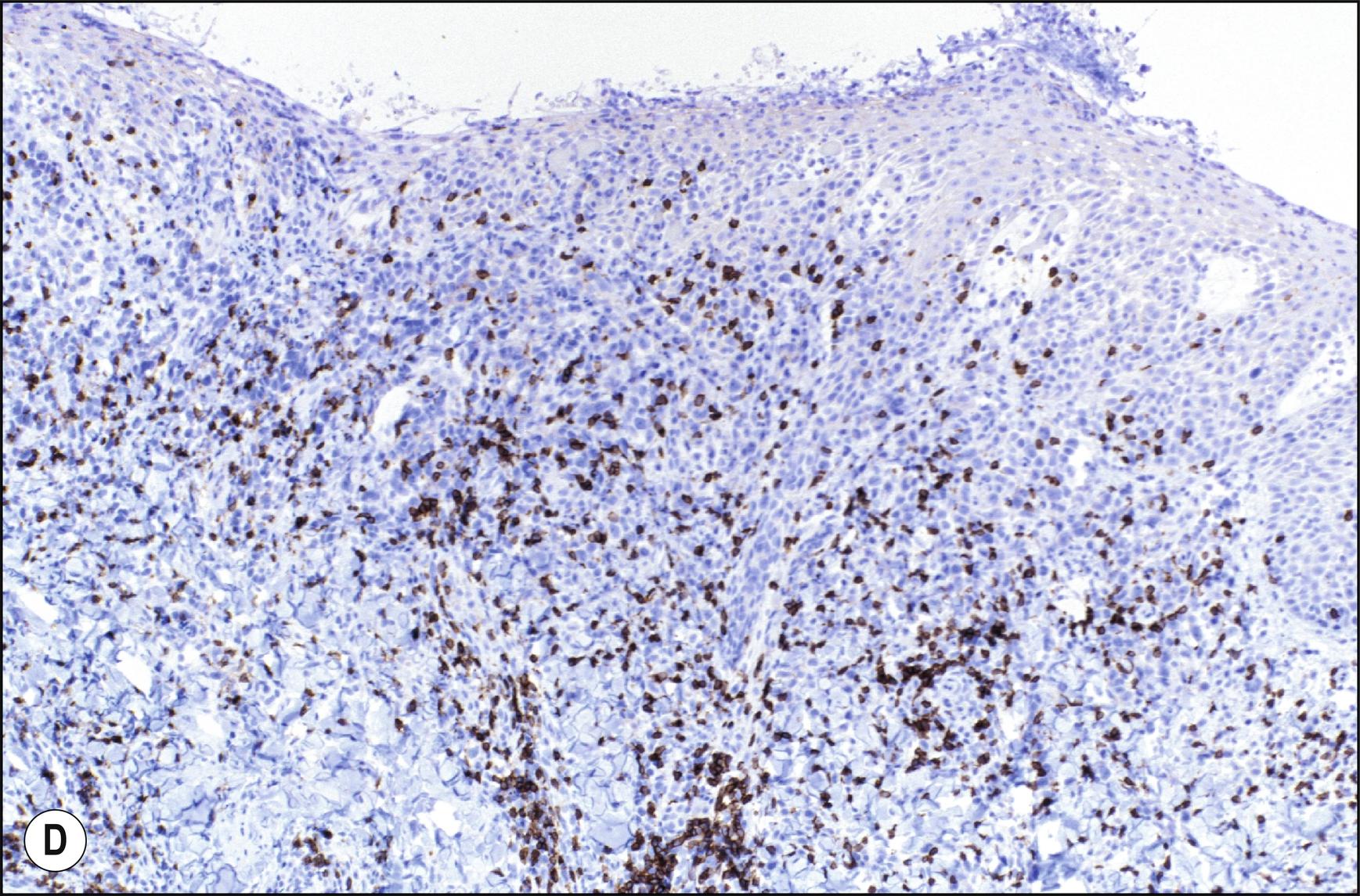 Fig. 24.5, D Lymphomatoid papulosis (CD3 stain).
