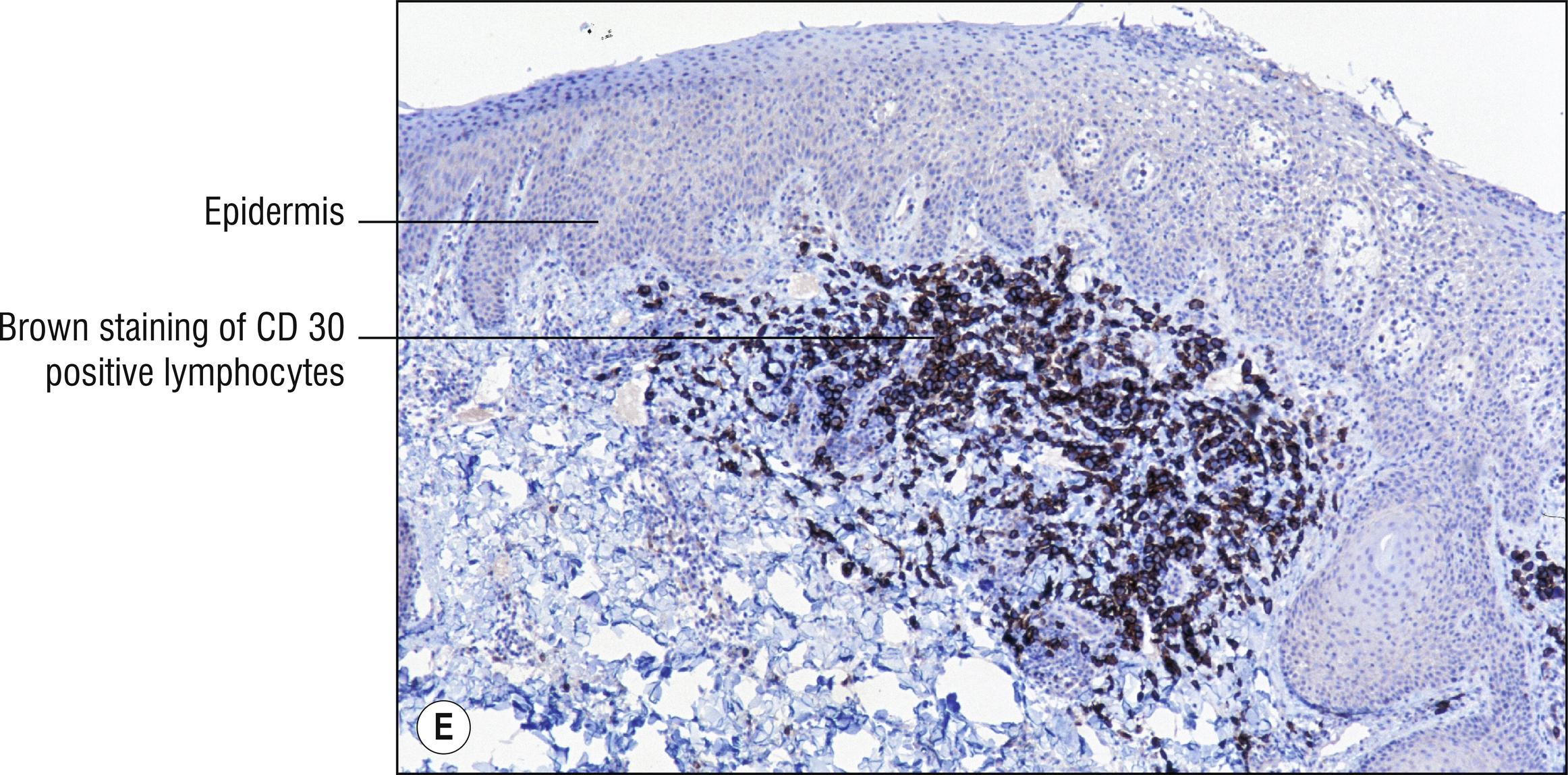 Fig. 24.5, E Lymphomatoid papulosis (CD30 stain).