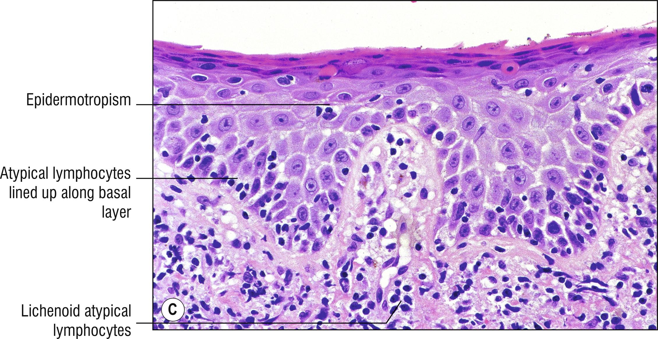 Fig. 24.1, C Mycosis fungoides (medium mag.).